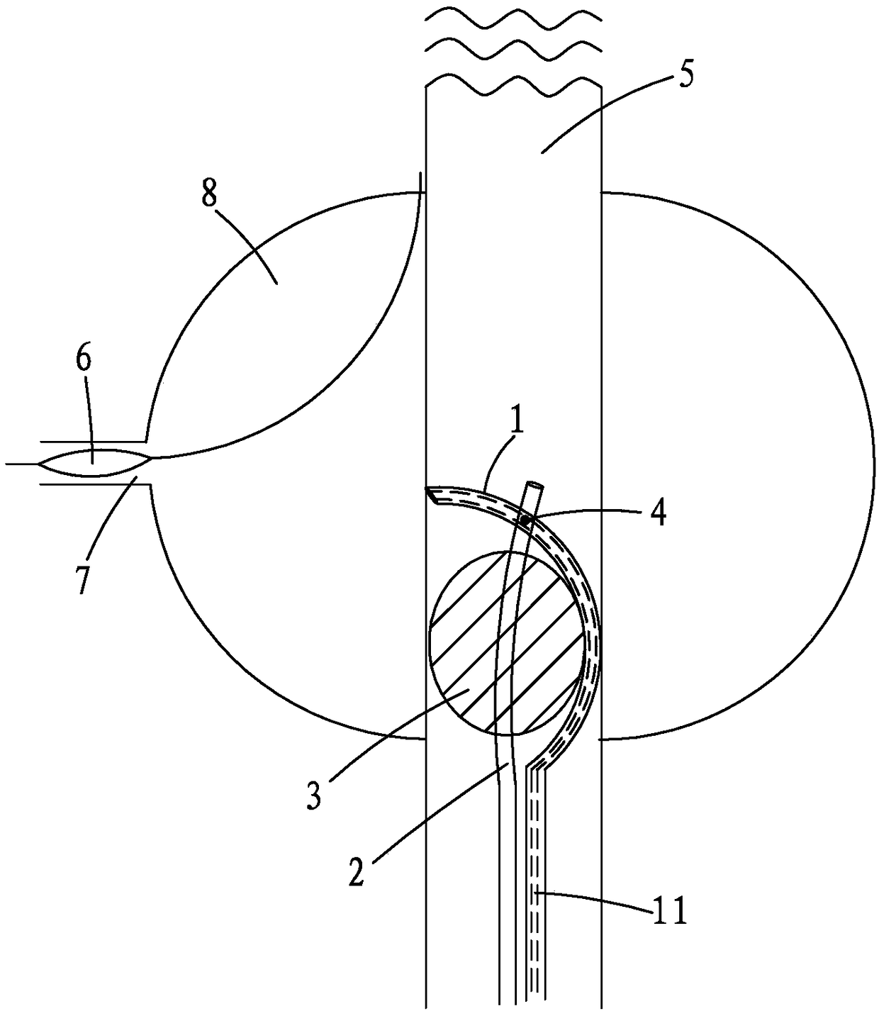 Intervention therapy device and method of use for realizing steering and positioning fenestration through laser catheter