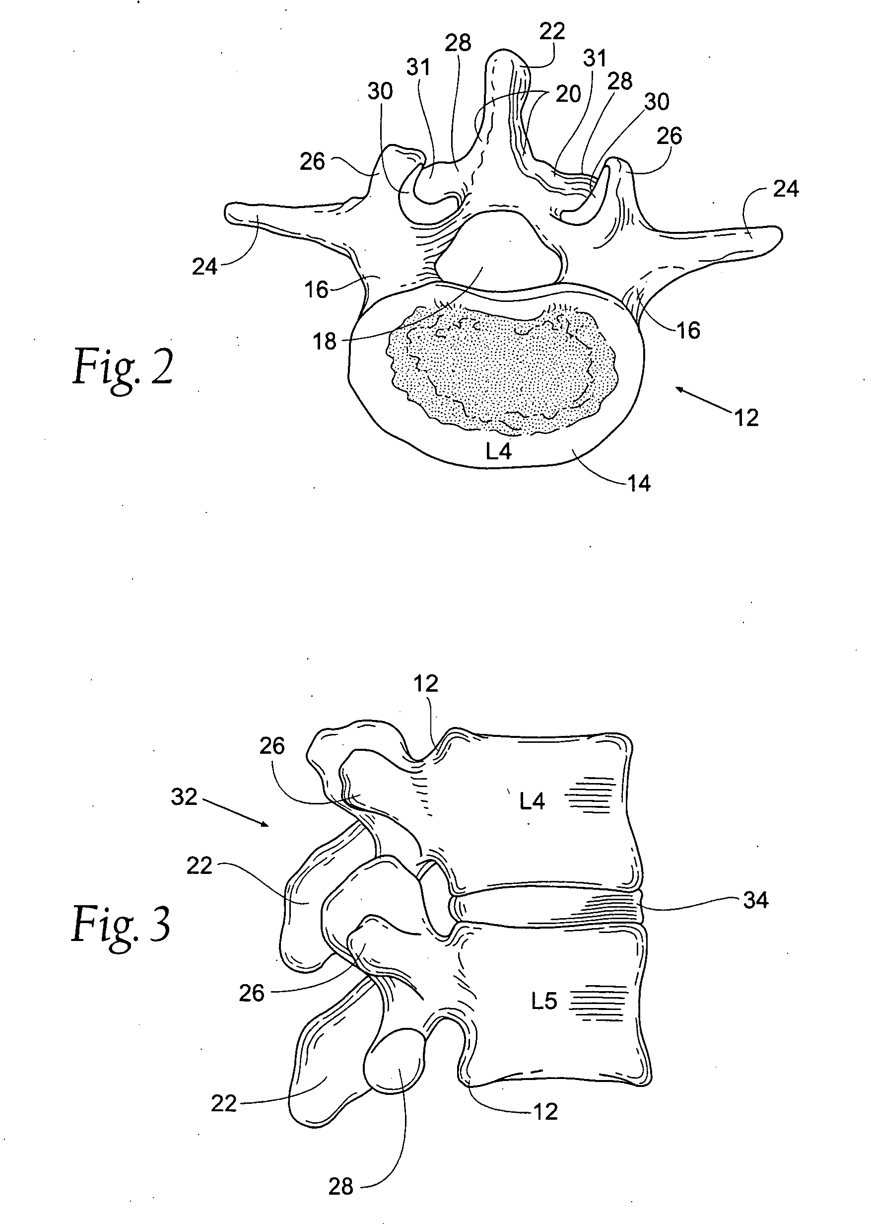 Prostheses, systems and methods for replacement of natural facet joints with artificial facet joint surfaces