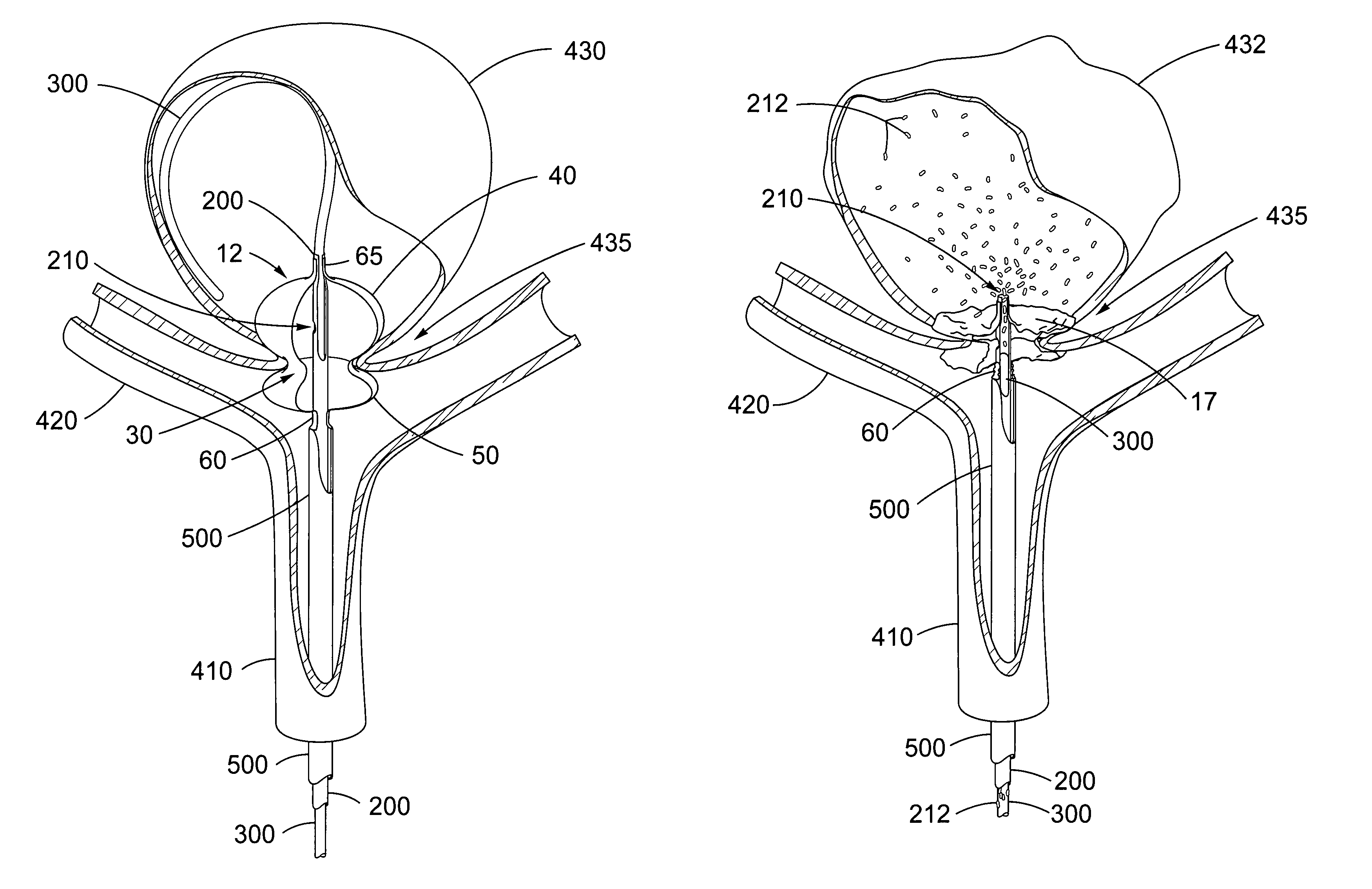 Over-the-wire exclusion device and system for delivery