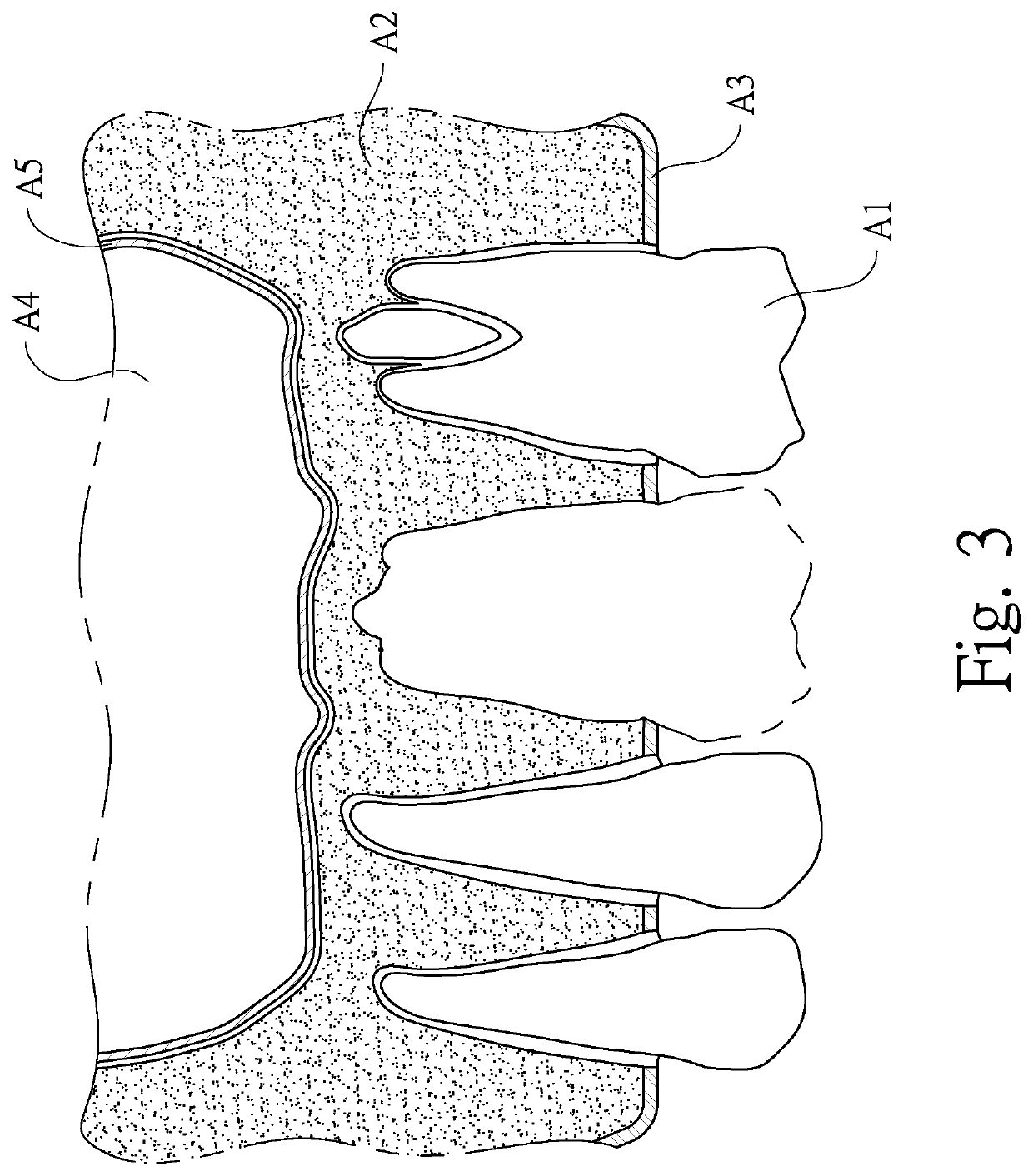 Dental implant instrument set and sinus curettes for vertically displacing sinus mucosa to form a space for bone augmentation