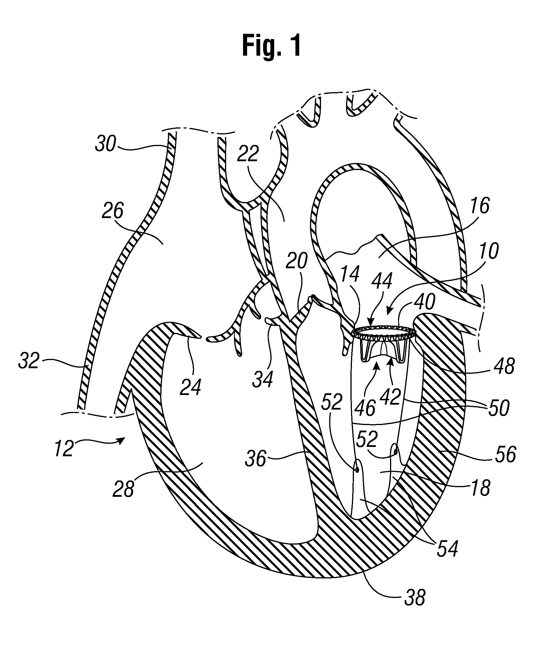 Prosthetic mitral valve with ventricular tethers and methods for implanting same