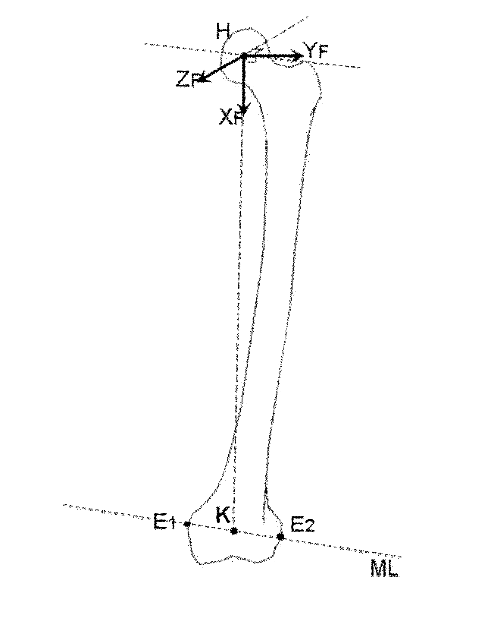 Method for determining articular bone deformity resection using motion patterns
