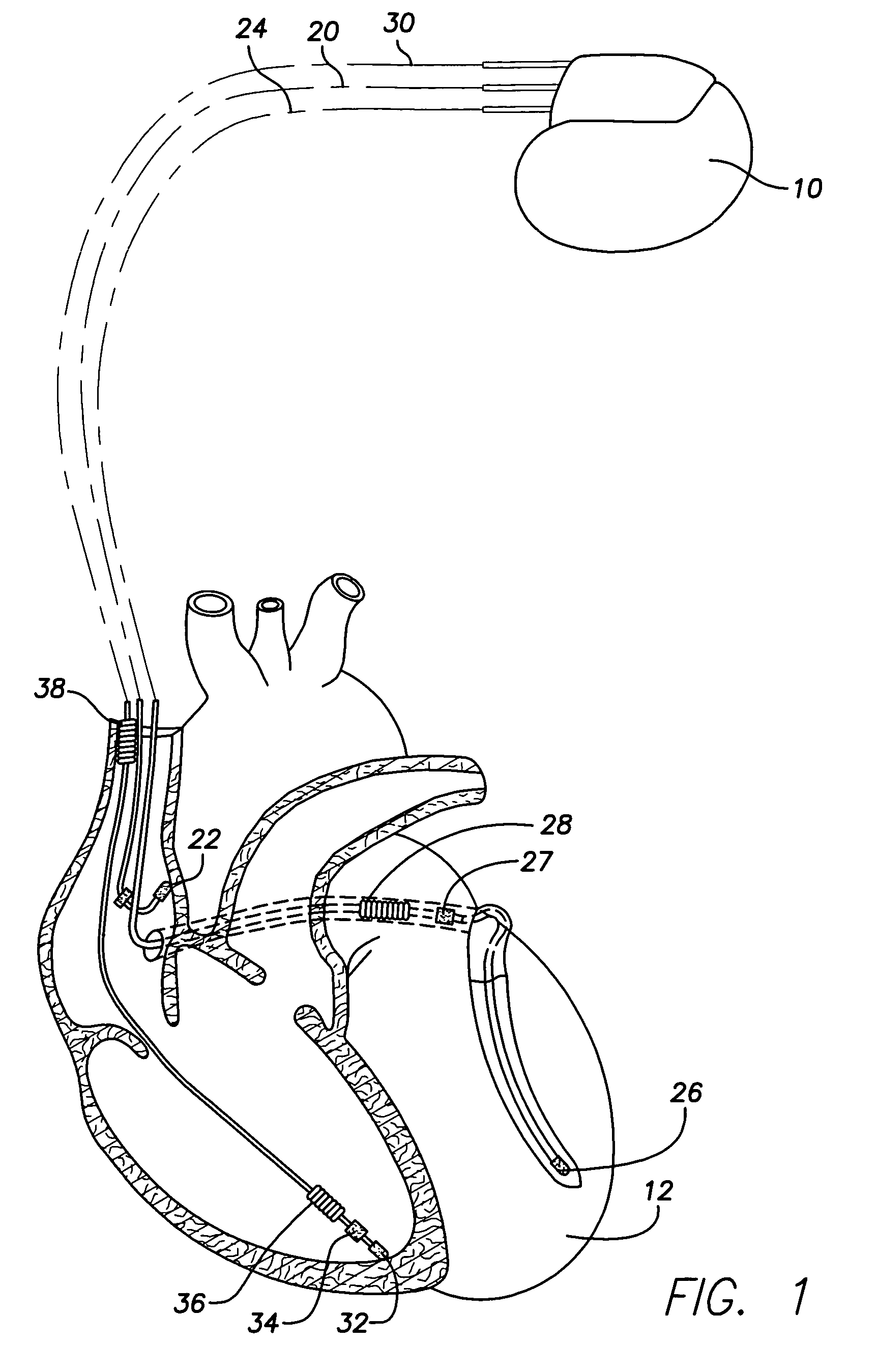 Implantable cardiac device providing rapid pacing T wave alternan pattern detection and method