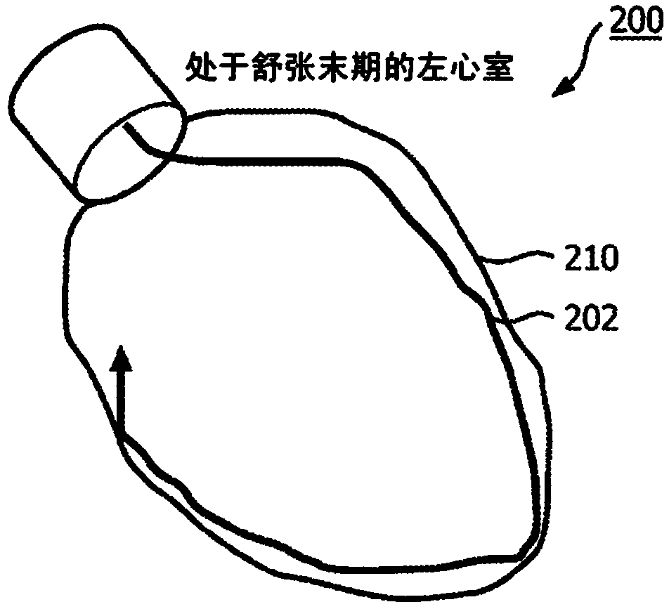 Shape sensing devices for real-time mechanical function assessment of an internal organ