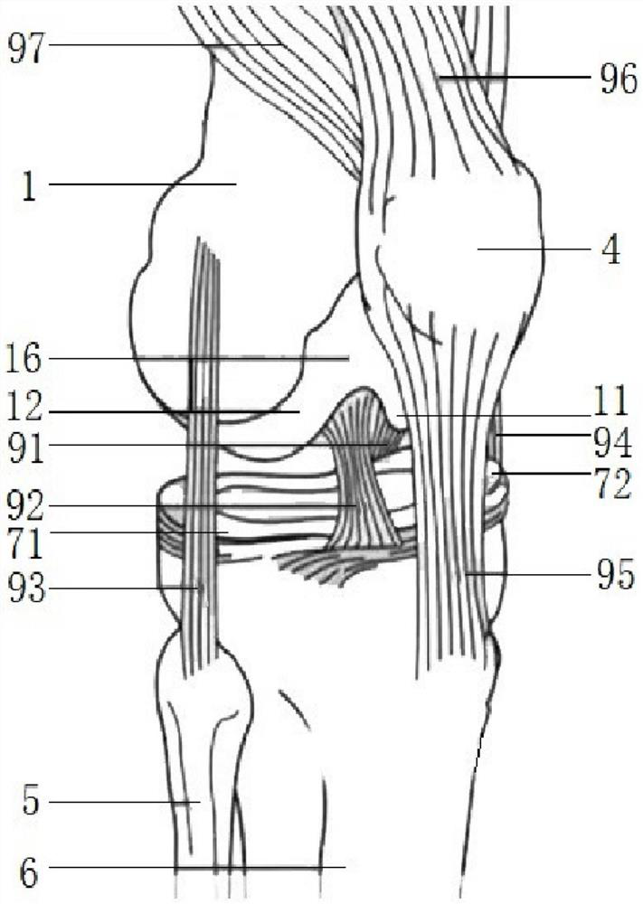 An anatomical knee joint femoral prosthesis retaining posterior cruciate ligament