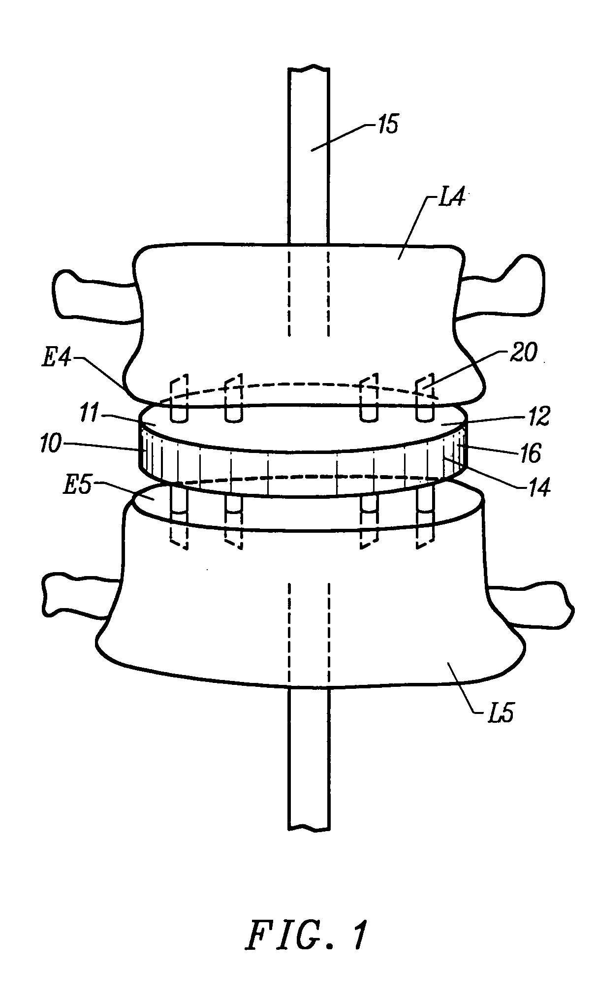 Method and apparatus for intervertebral implant anchorage