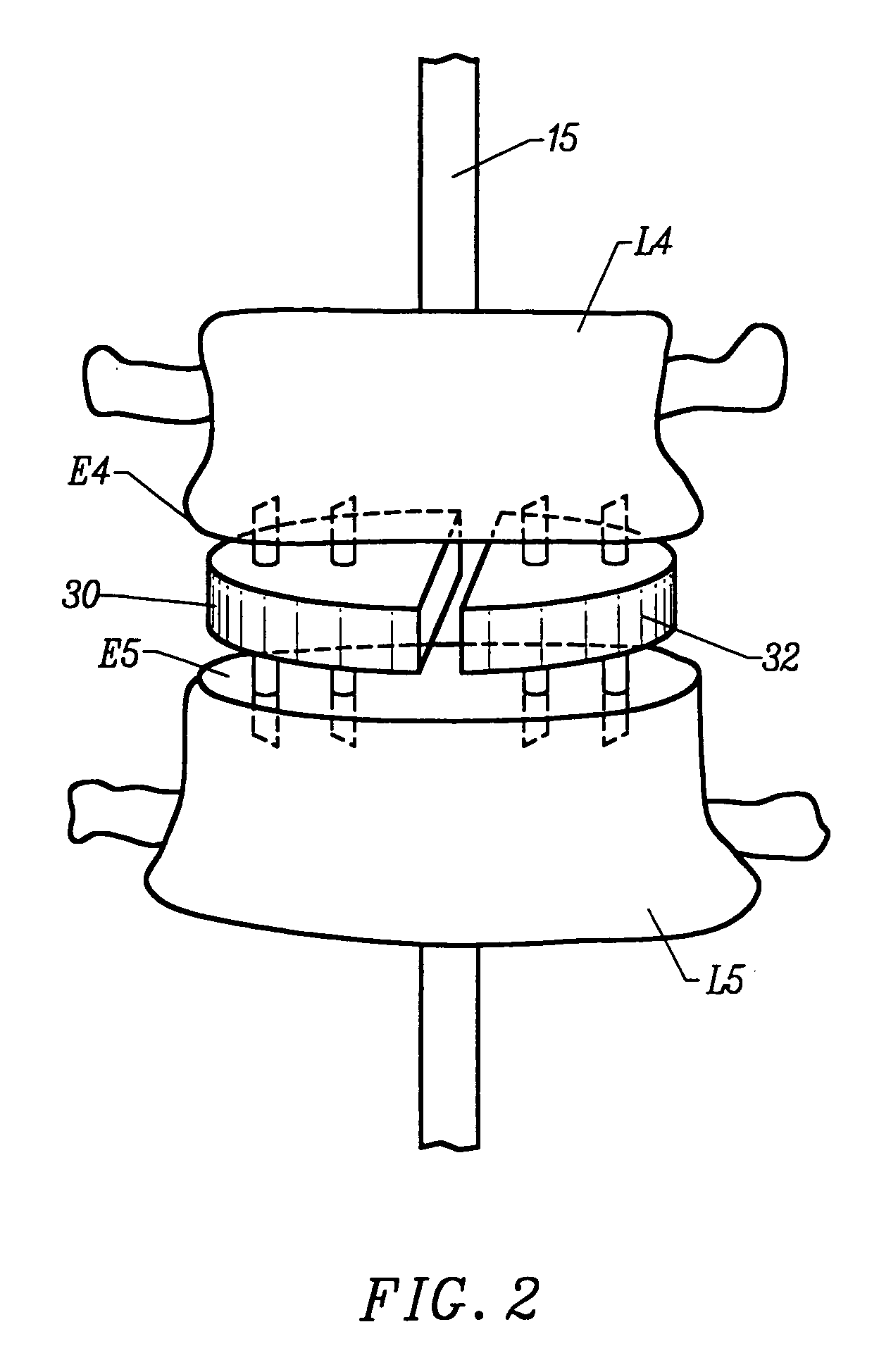 Method and apparatus for intervertebral implant anchorage