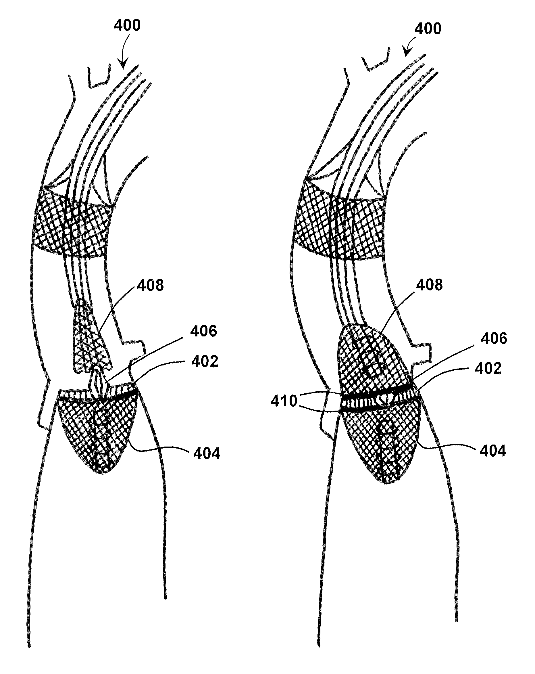 Methods for removing a valve from a vessel