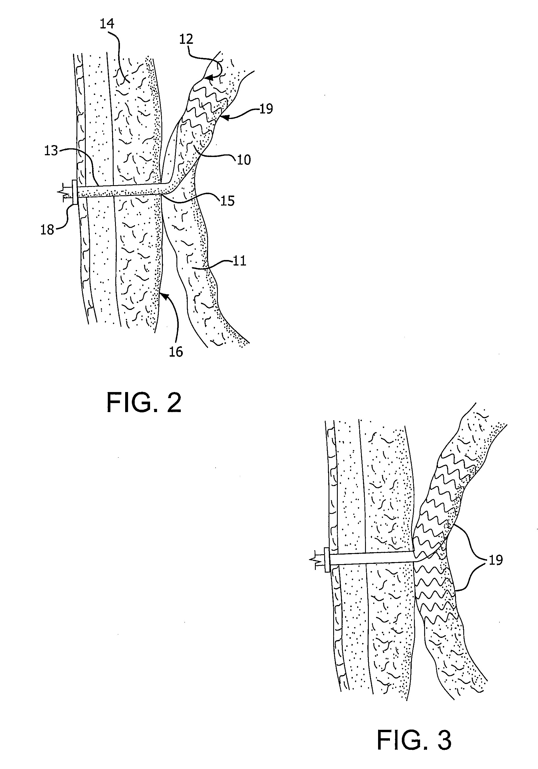 Medical Device for use with a Stoma