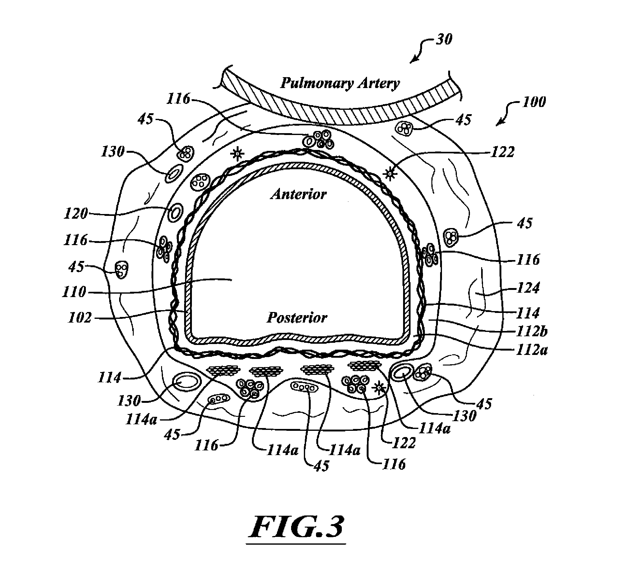 Systems, devices, and methods for treating a pulmonary disorder with an agent