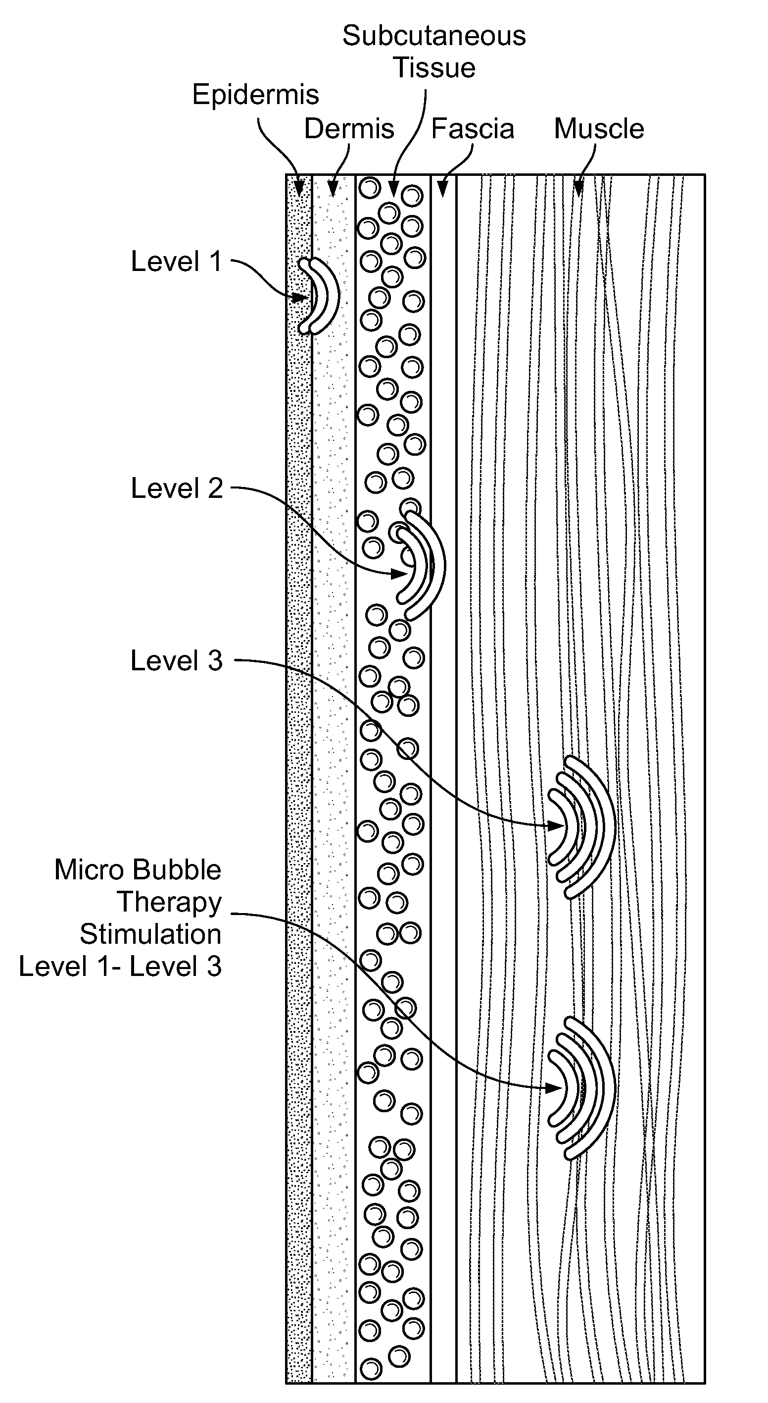 Microbubble therapy method and generating apparatus