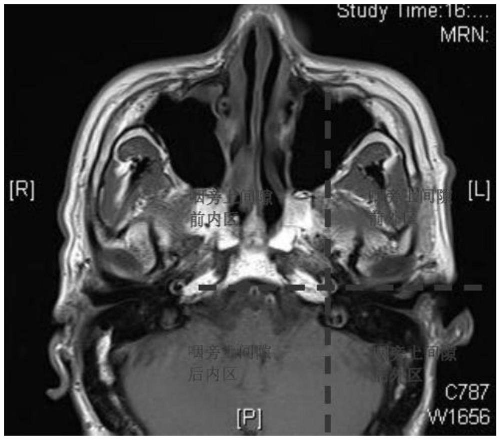 Endoscopic para-pharyngeal space tumor excision method