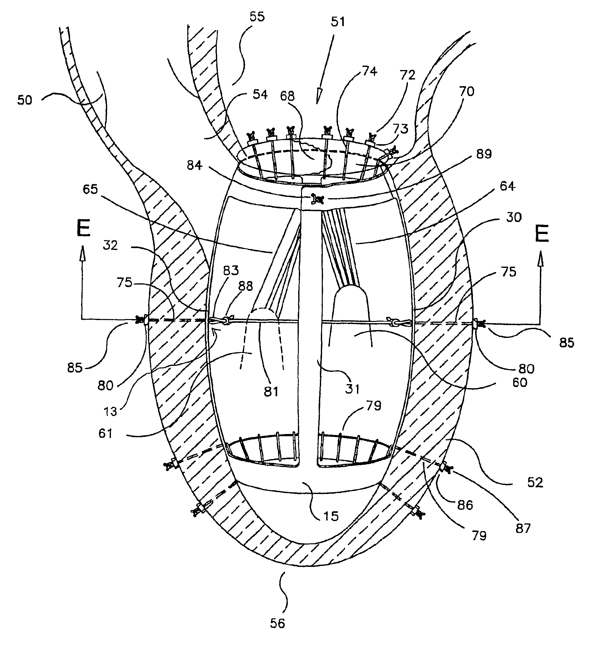 Method and apparatus for the surgical treatment of congestive heart failure