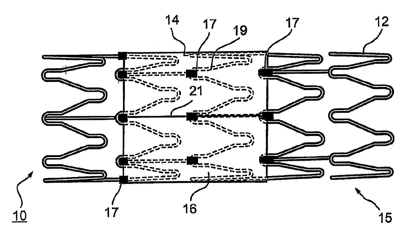 Implantable graft assembly and aneurysm treatment