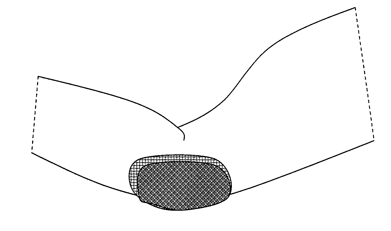 Method and device for treating bursitis