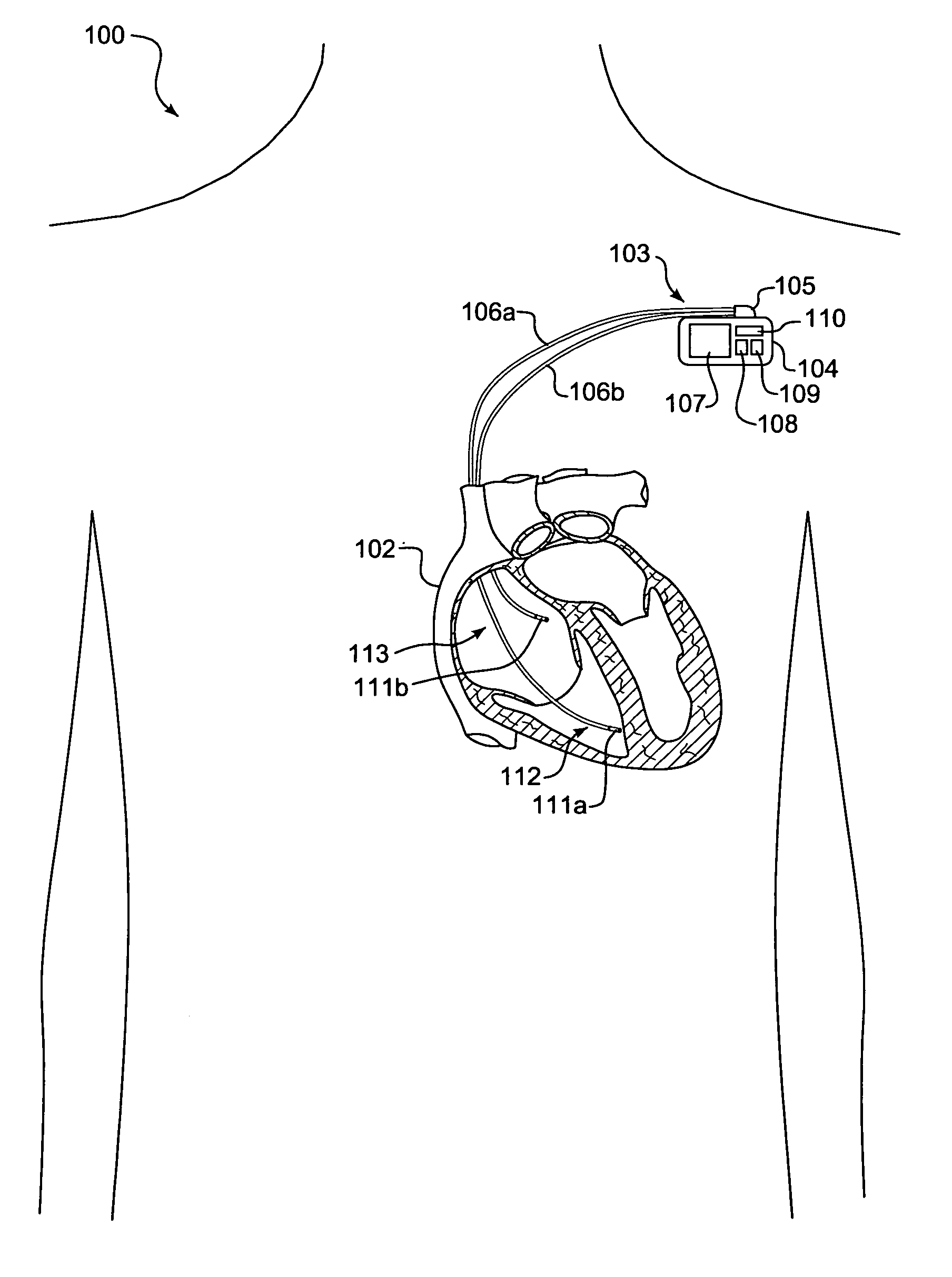 System and method for assessing cardiac performance through transcardiac impedance monitoring