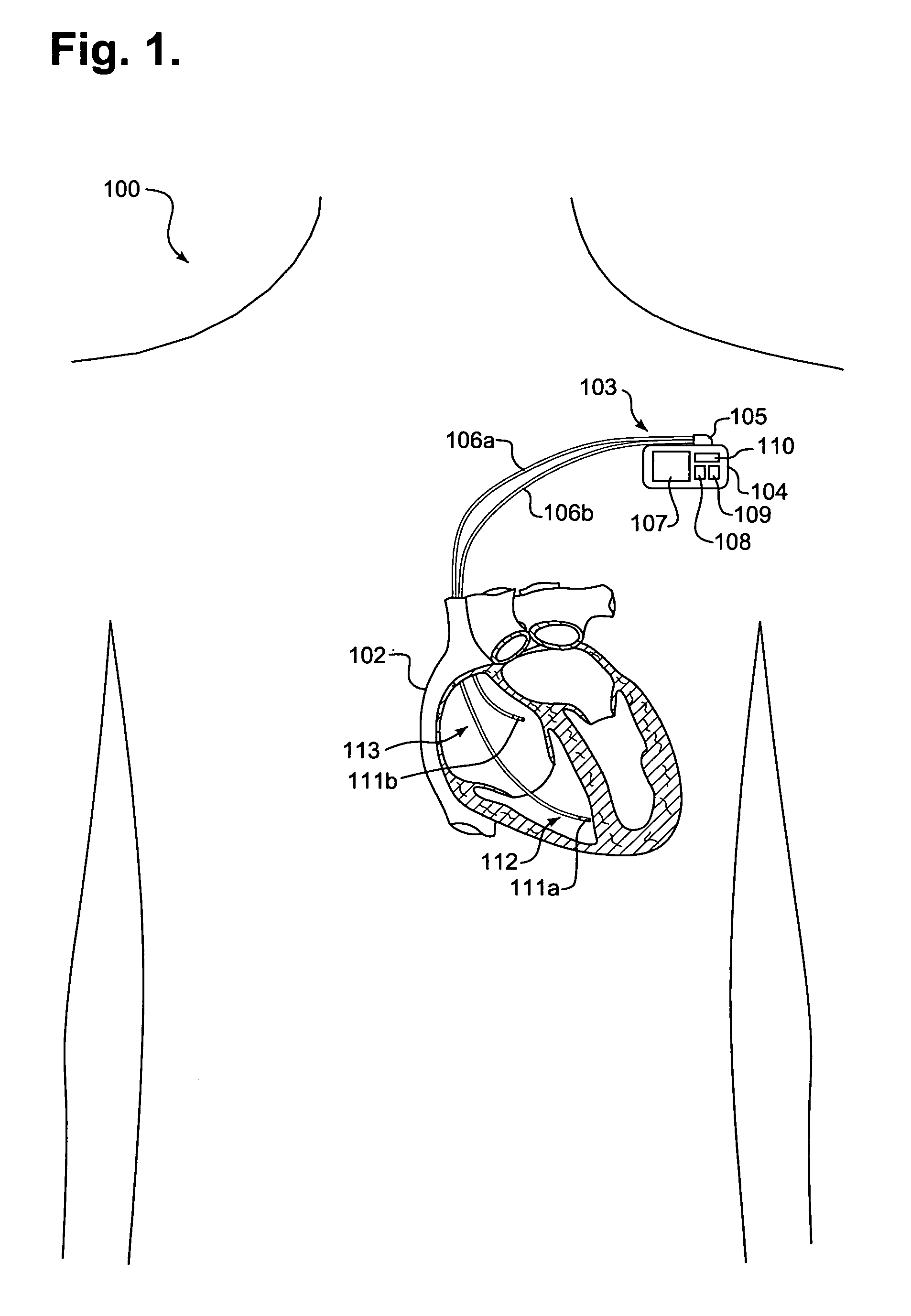 System and method for assessing cardiac performance through transcardiac impedance monitoring