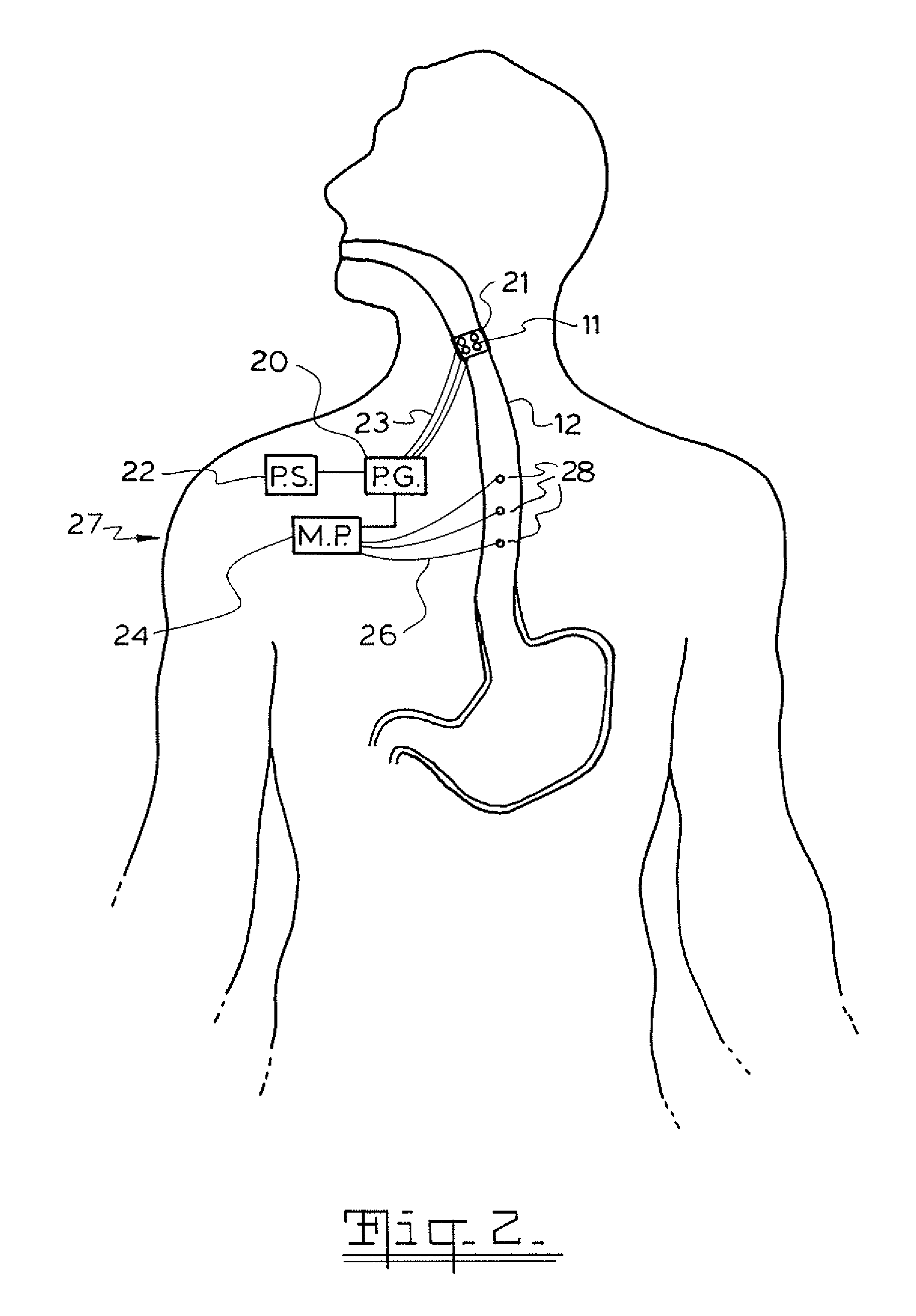 Method and apparatus for treatment of the gastrointestinal tract