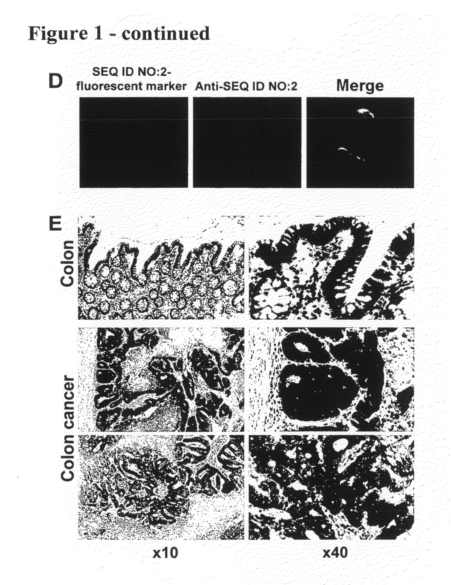 Methods and compositions for diagnosis and treatment of cancer