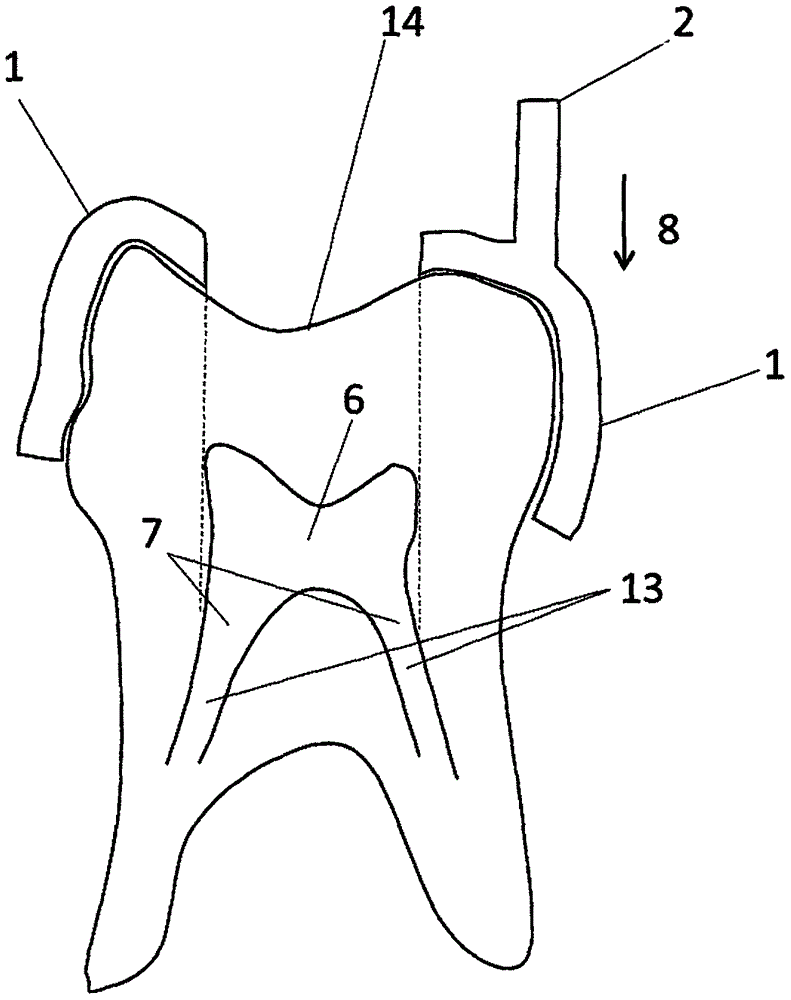 Guiding device for tooth coronal cavity preparation and making method thereof