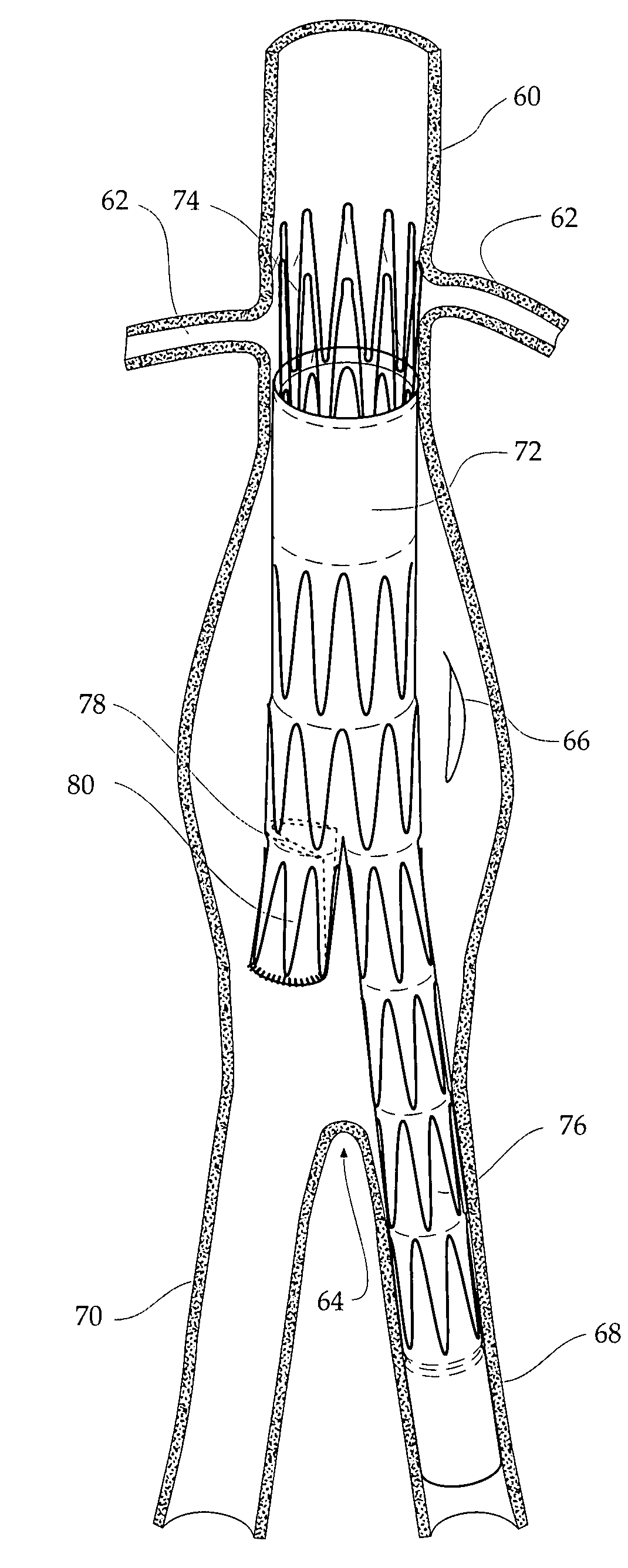 Stent graft for treatment of emergency rupture of a vessel