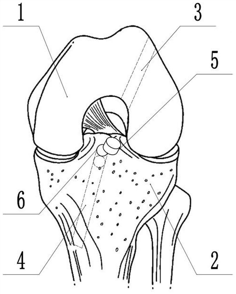 Bone tunnel preparation device for knee joint ligament reconstruction
