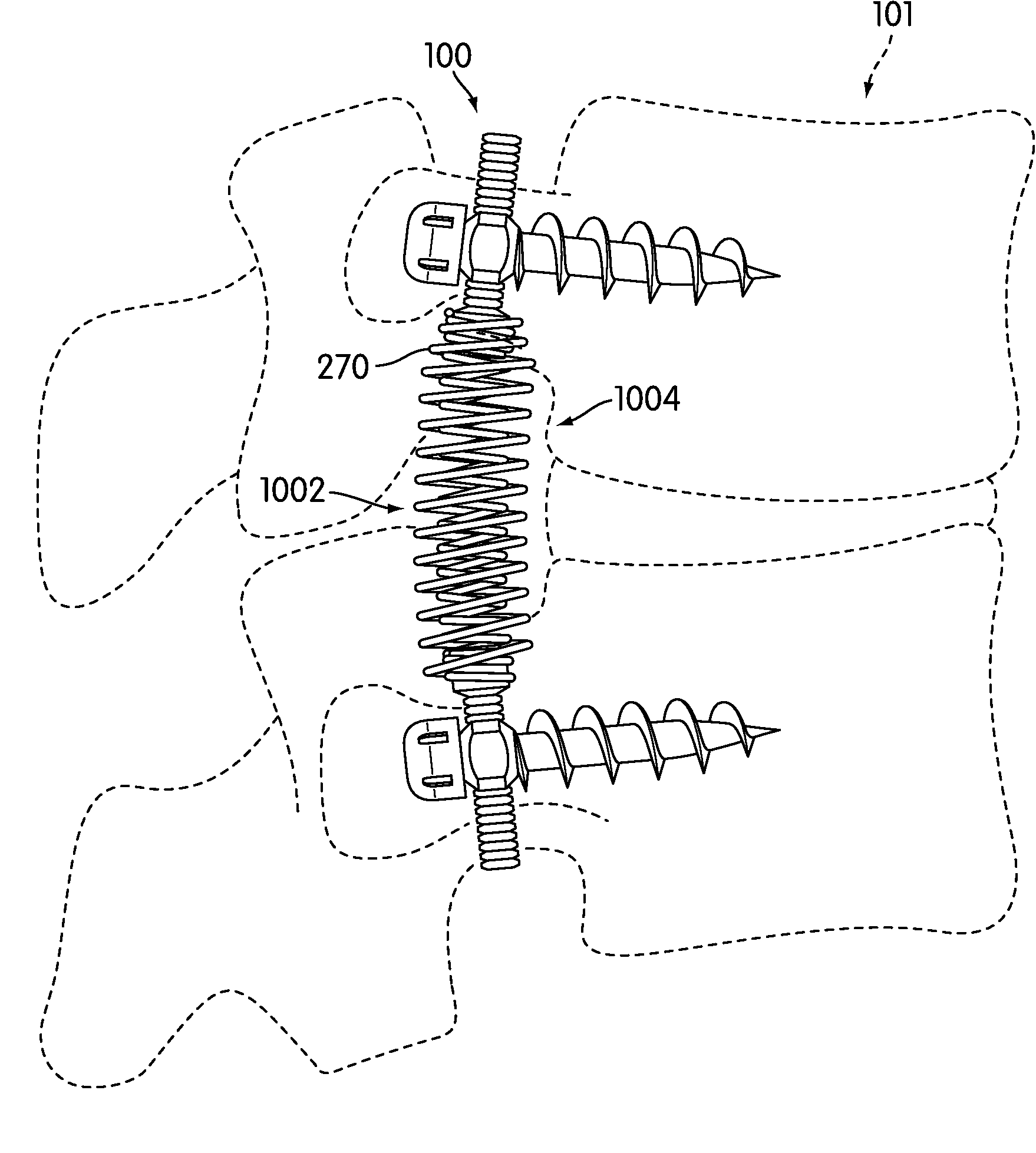 Dynamic Stabilization Device for Spine