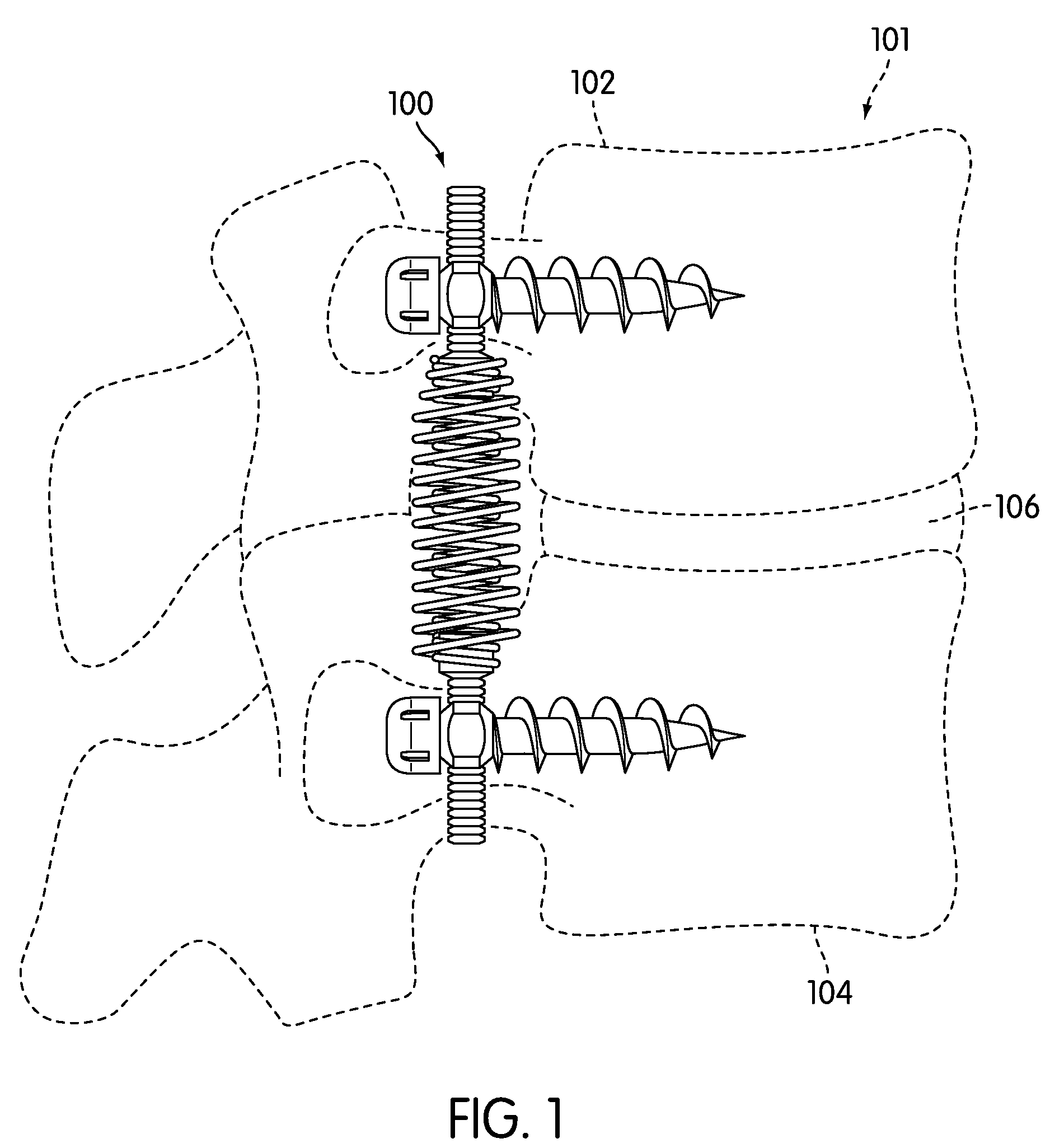 Dynamic Stabilization Device for Spine