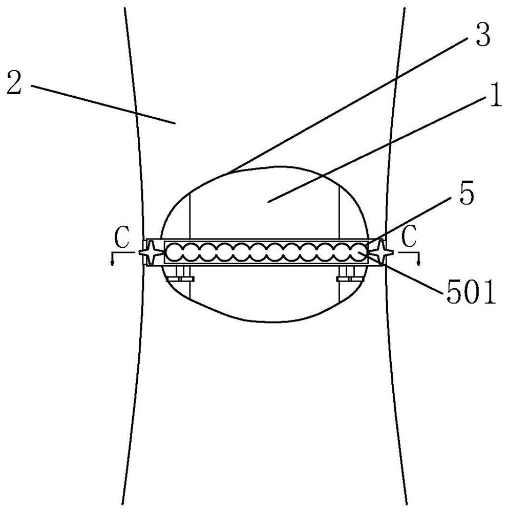 A minimally invasive embracing porous osteotomy device