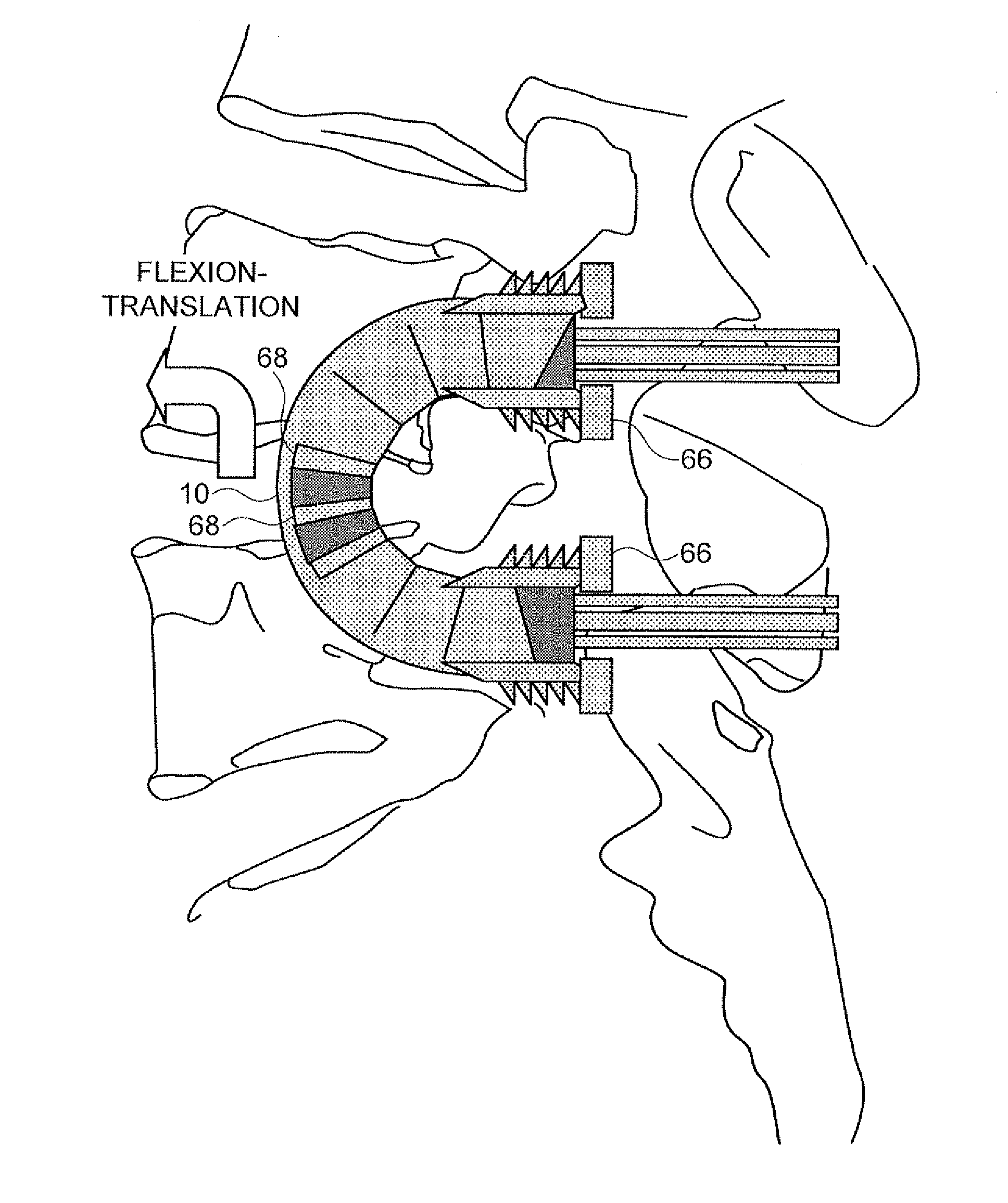 Devices For Introduction Into A Body Via A Substantially Straight Conduit To For a Predefined Curved Configuration, And Methods Employing Such Devices