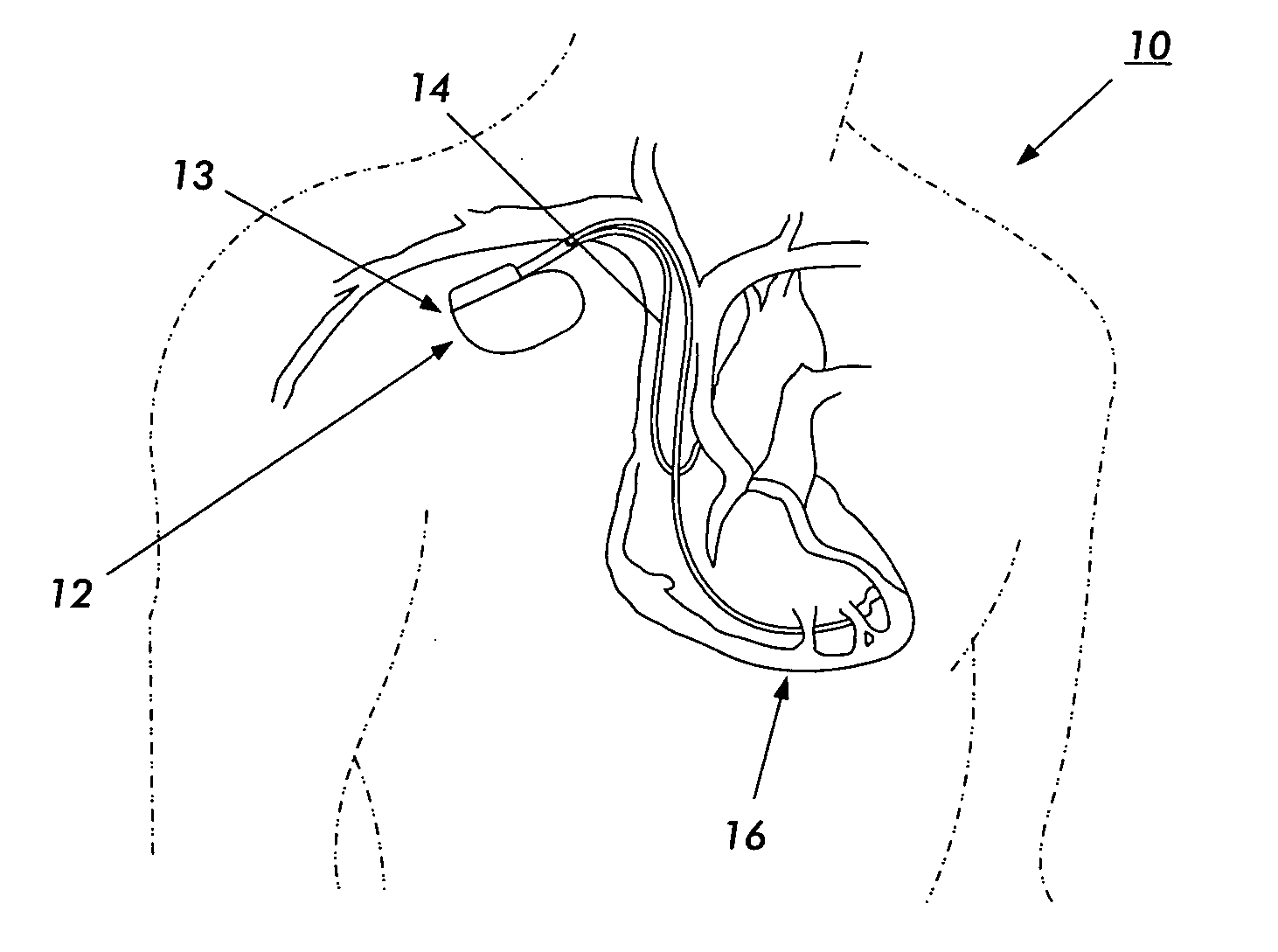 Medical device with an electrically conductive anti-antenna geometrical shaped member