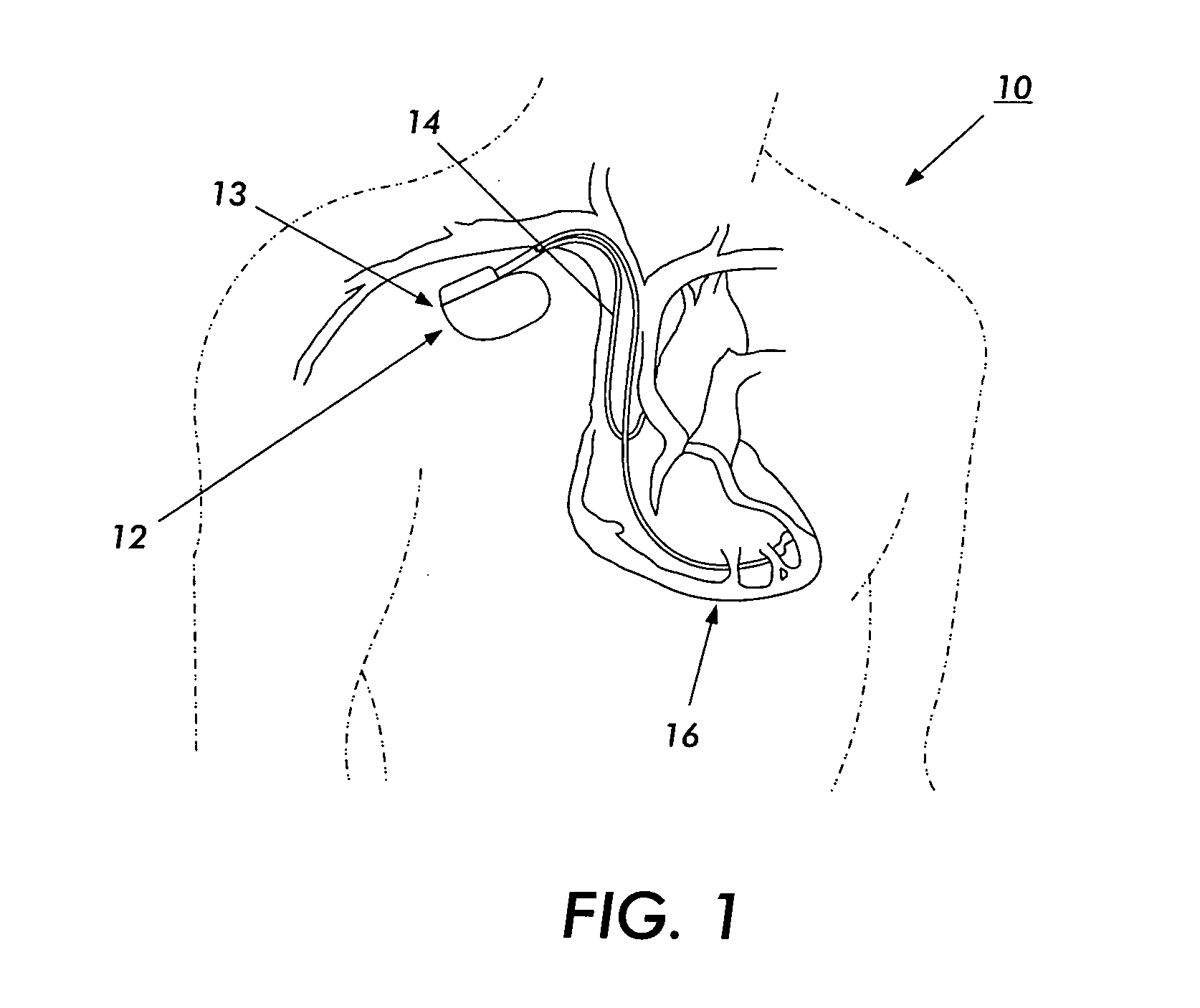 Medical device with an electrically conductive anti-antenna geometrical shaped member