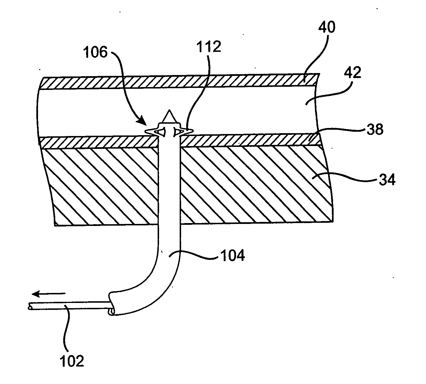 Devices and methods for use in performing transmyocardial coronary bypass
