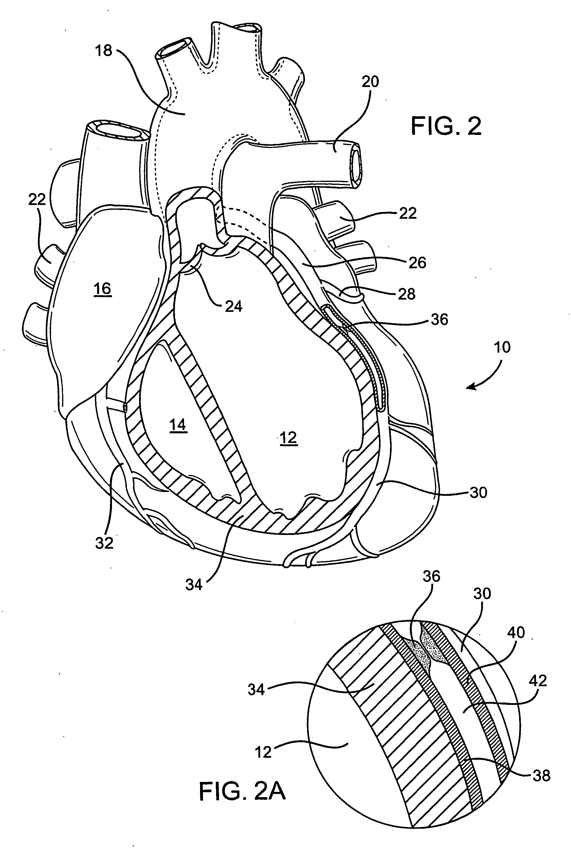 Devices and methods for use in performing transmyocardial coronary bypass