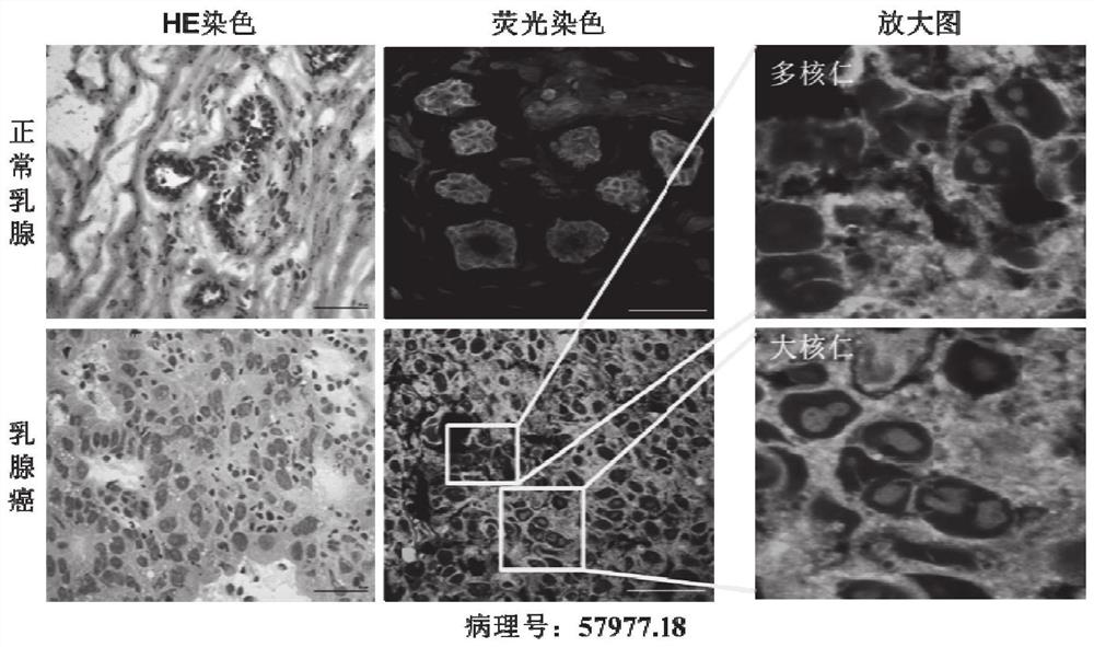 An RNA fluorescent probe that rapidly differentiates cancer from normal tissue using nucleolus morphological changes