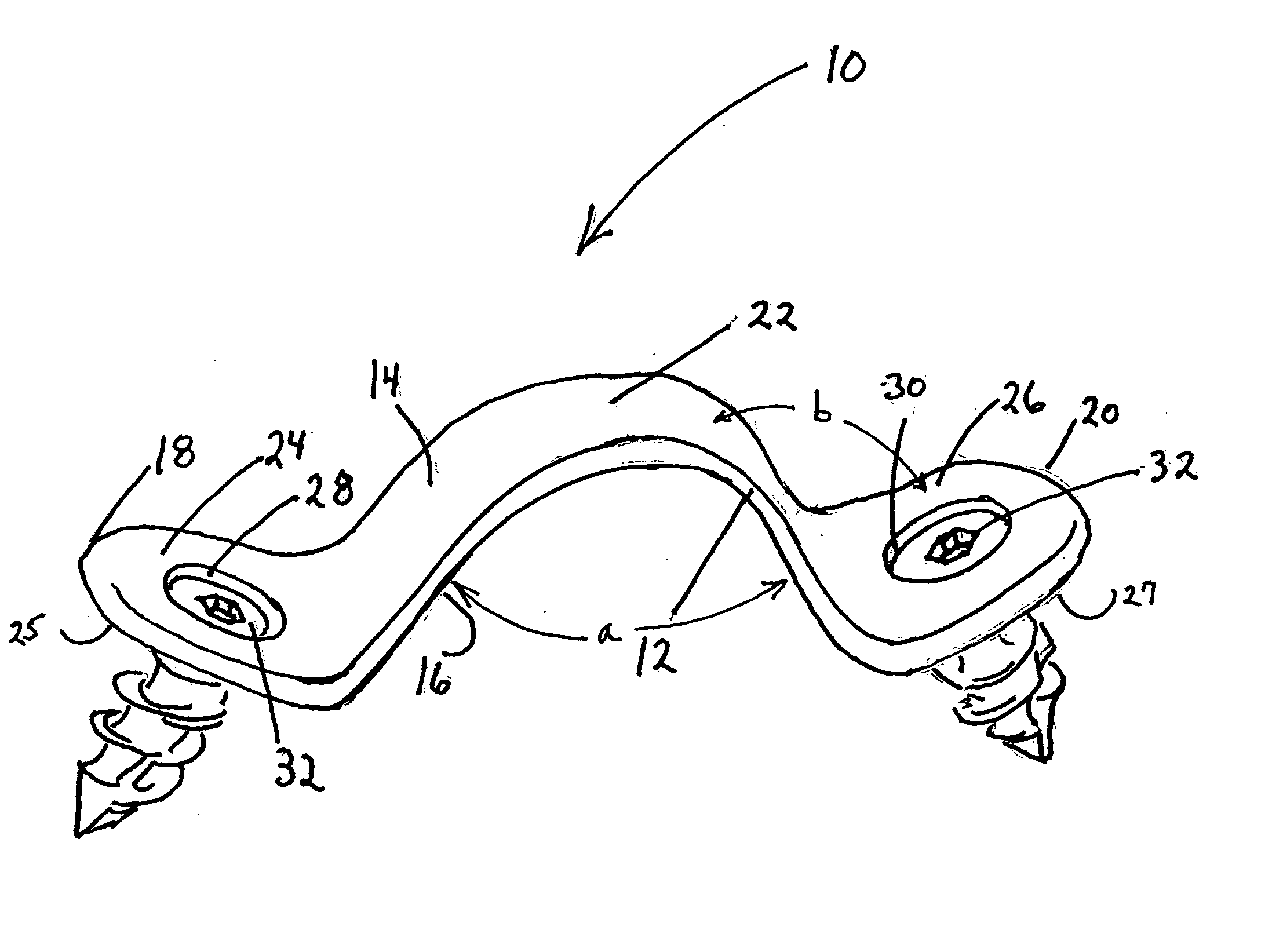 Facet triangle spinal fixation device and method of use
