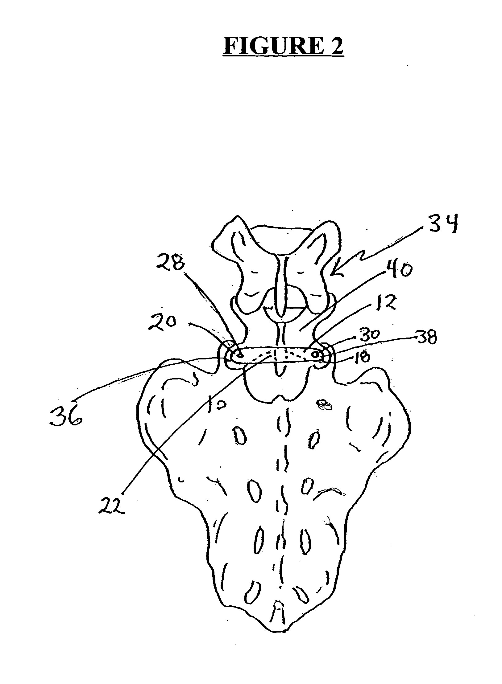 Facet triangle spinal fixation device and method of use