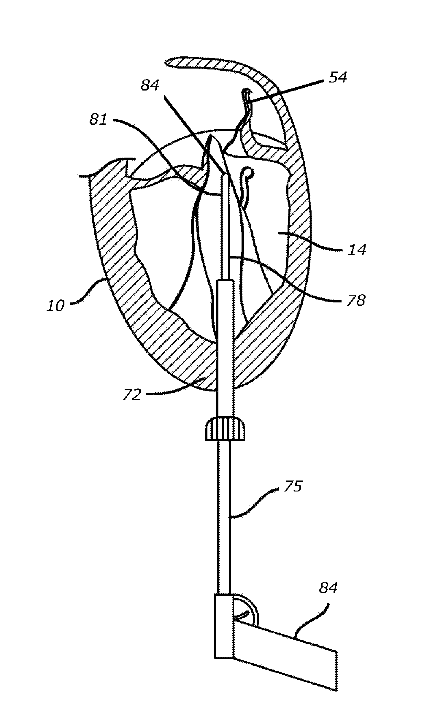 Transapical mitral valve repair device