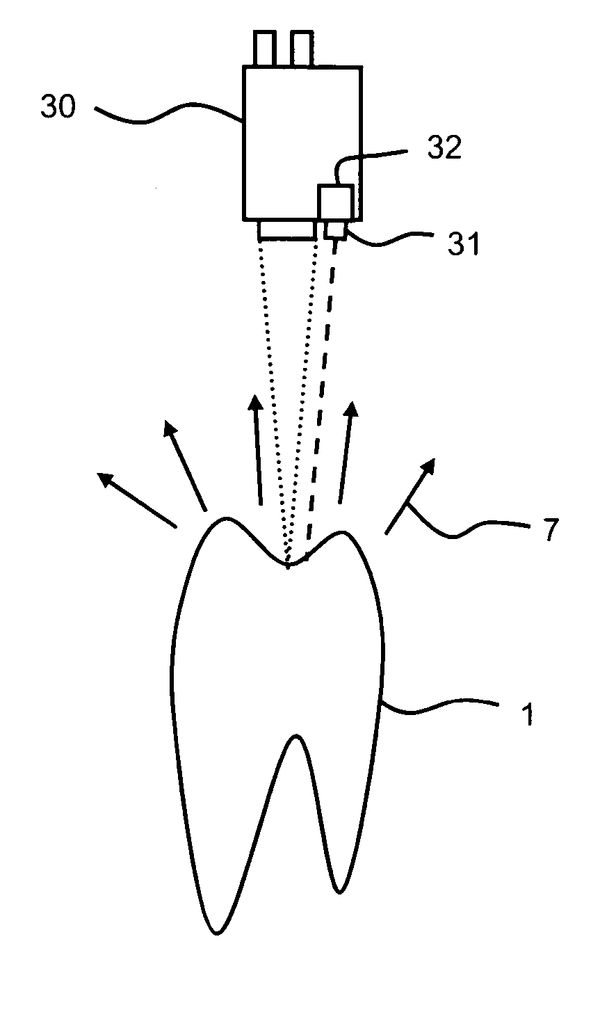 Method and apparatus for identifying tooth-coloured tooth filling residues