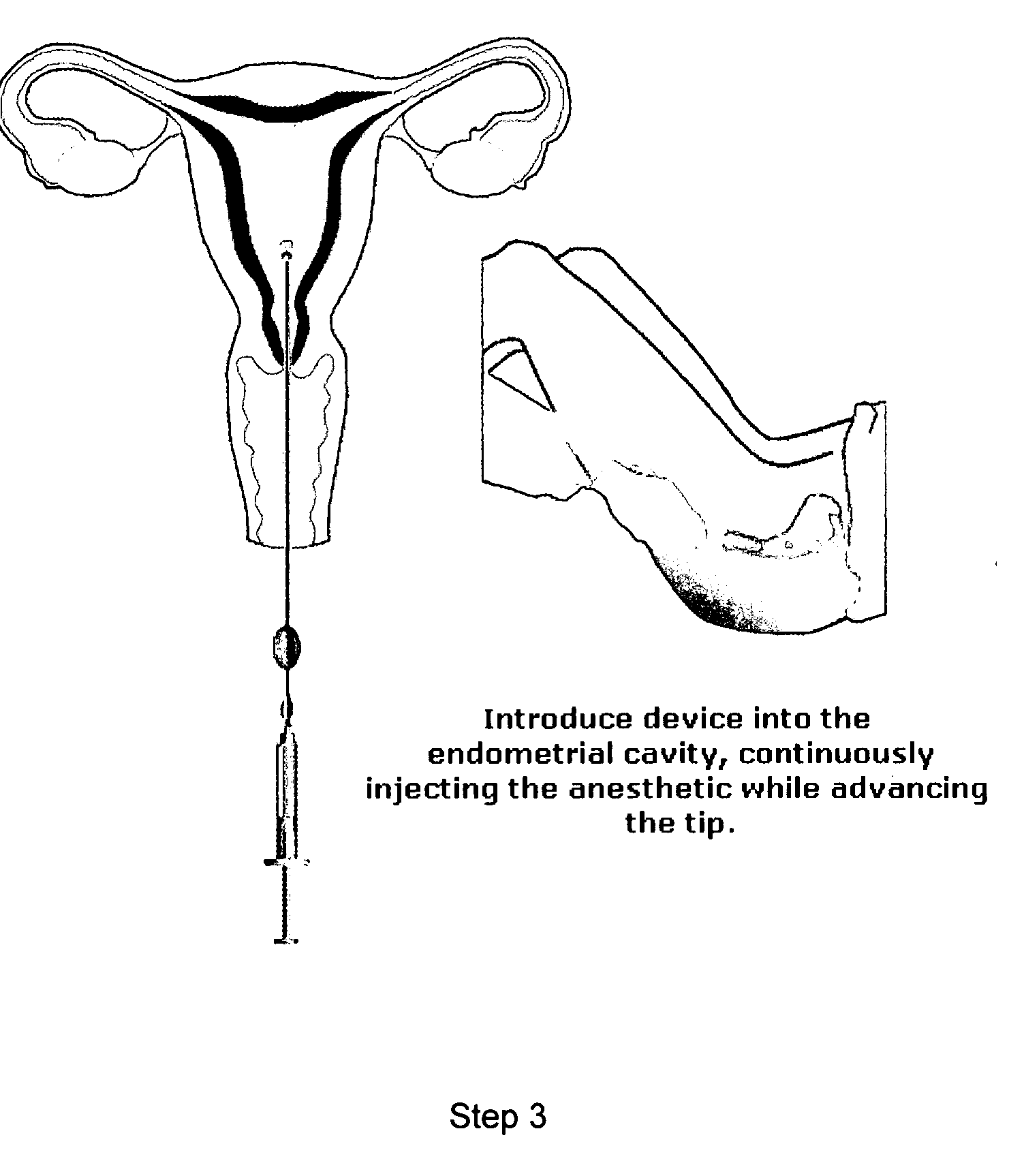 Endometrial anesthesia delivery device and methods of use thereof