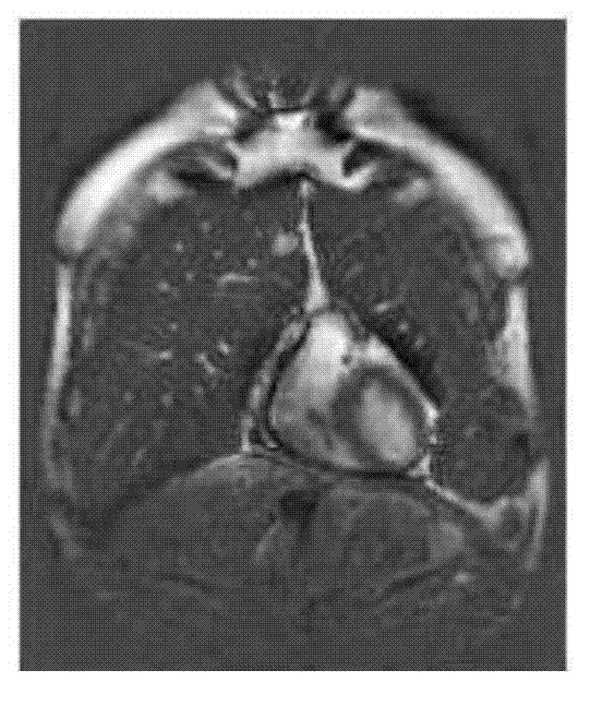 Heart magnetic resonance imaging (MRI) image deblurring method based on sparse low rank and dictionary learning