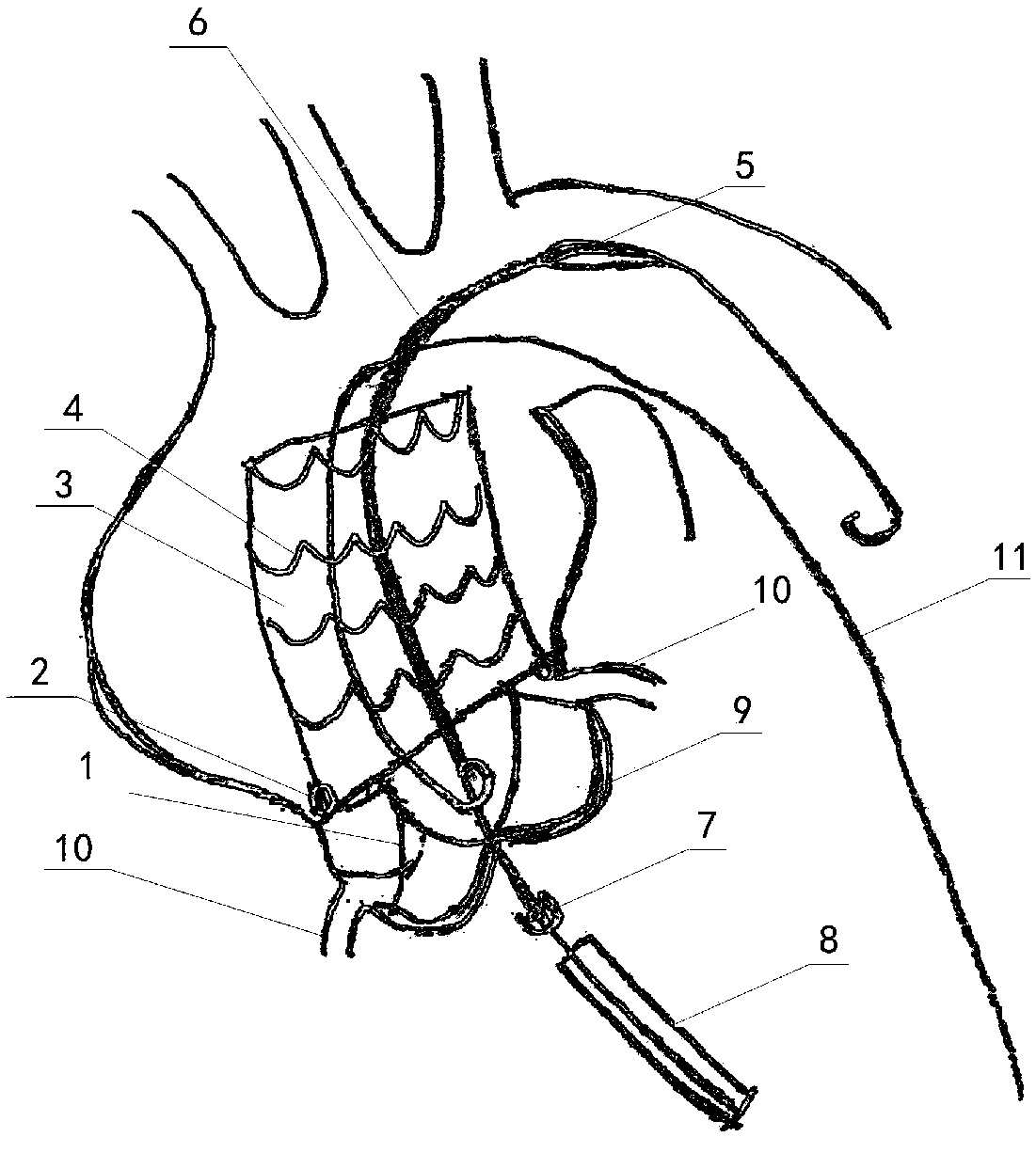 Ascending aorta covered stent released by transapical approach