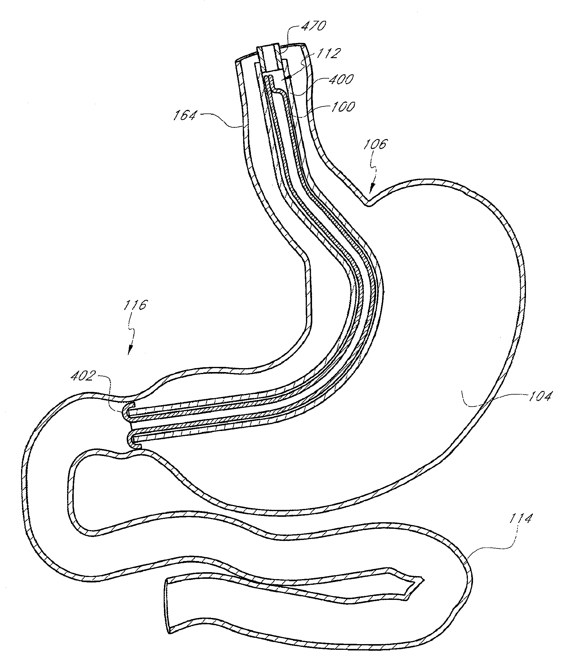Methods for toposcopic sleeve delivery