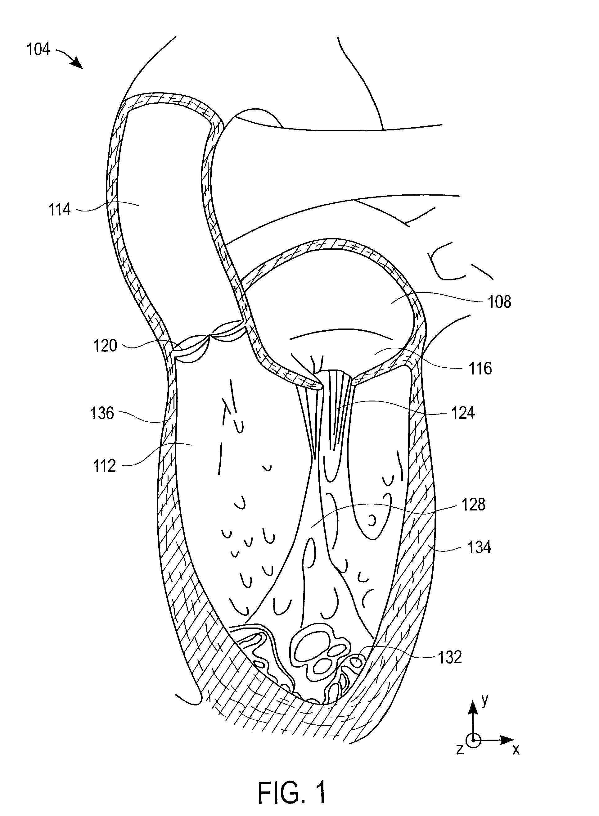Method and apparatus for catheter-based annuloplasty using local plications