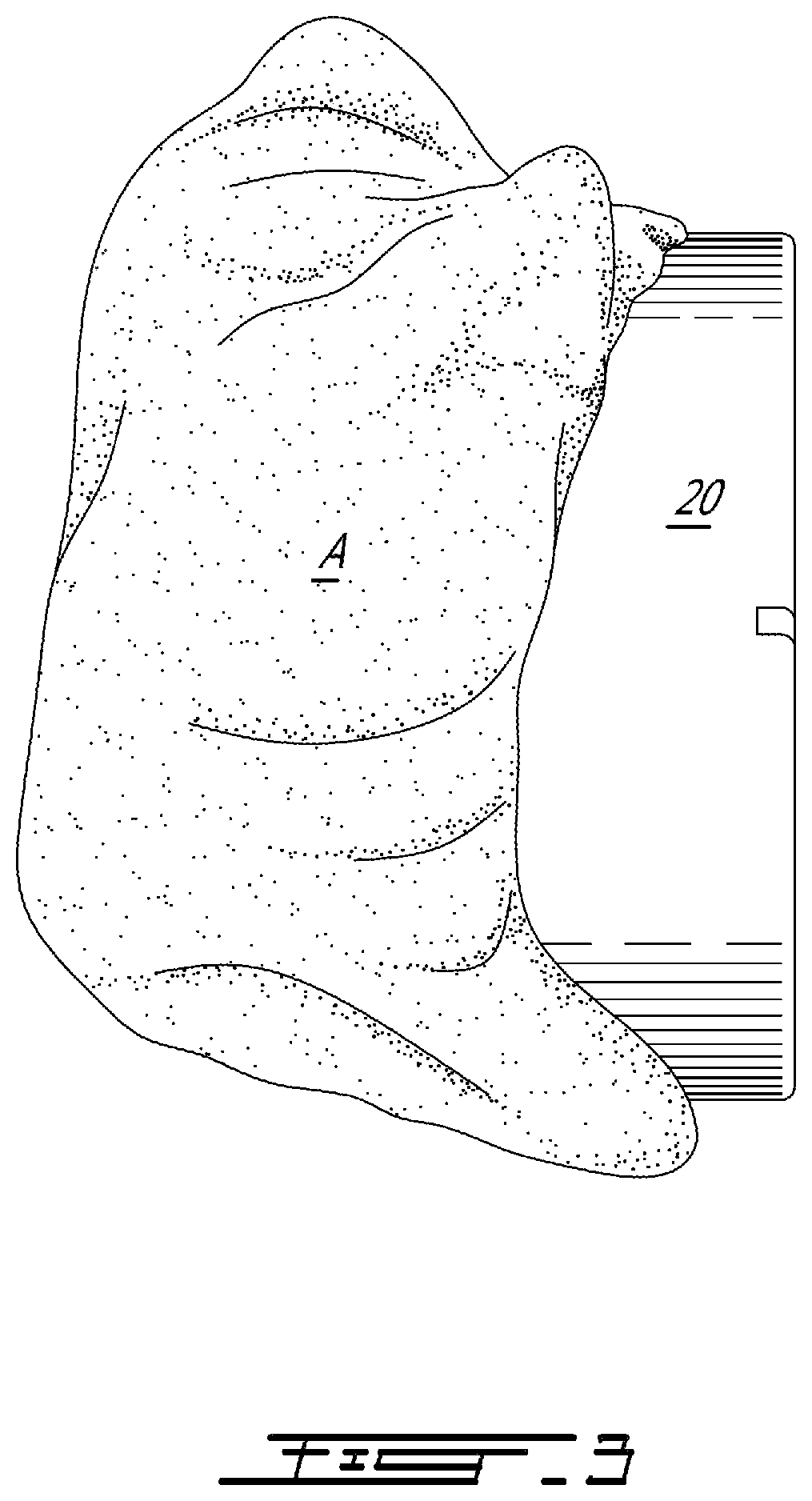 Patient-specific instrumentation for patellar resurfacing surgery and method