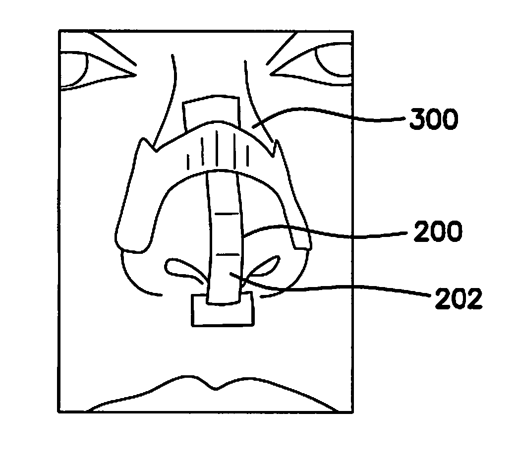 Vertical and horizontal nasal splints and methods of use