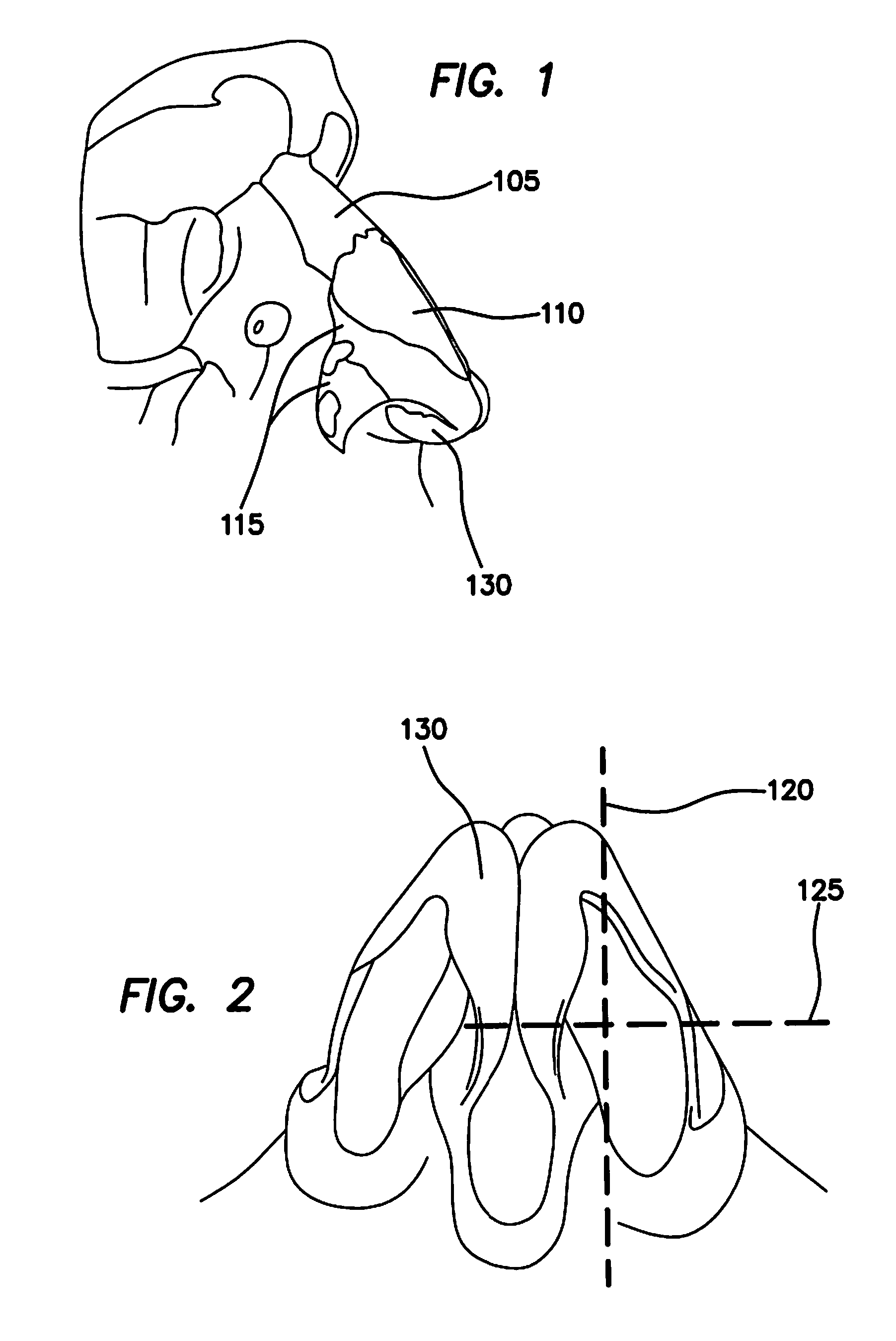 Vertical and horizontal nasal splints and methods of use