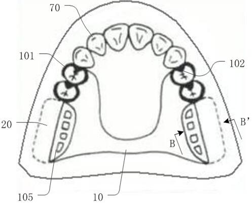 A removable partial denture and its manufacturing process
