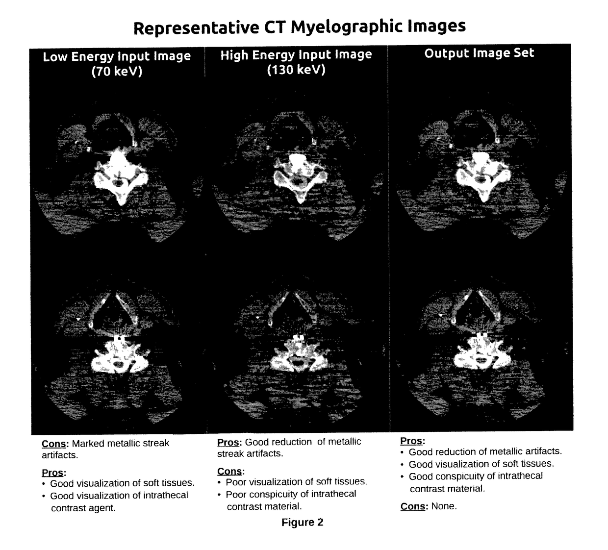 Method for Reduction of Artifacts and Preservation of Soft Tissue Contrast and Conspicuity of Iodinated Materials on Computed Tomography Images by means of Adaptive Fusion of Input Images Obtained from Dual-Energy CT Scans, and Use of differences in Voxel intensities between high and low-energy images in estimation of artifact magnitude