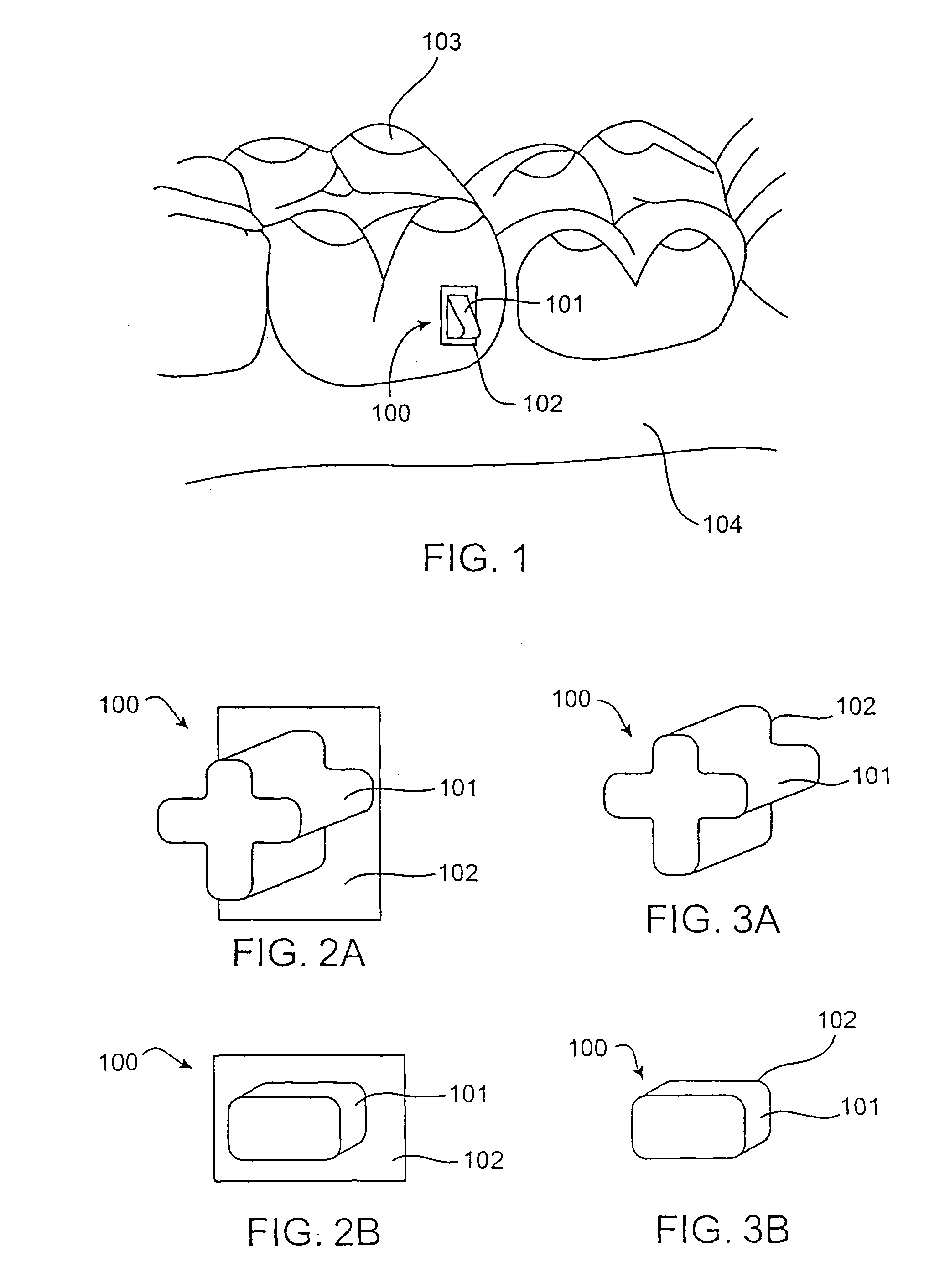 Attachment devices and methods for a dental appliance
